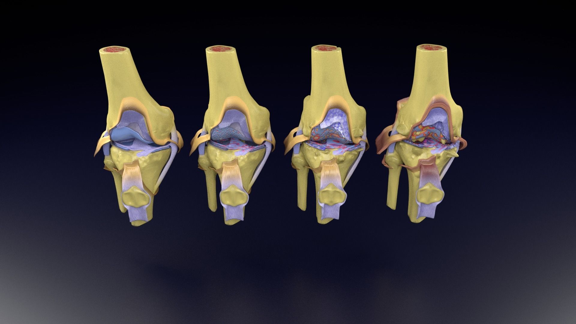Osteoarthritis stages 3D model_97