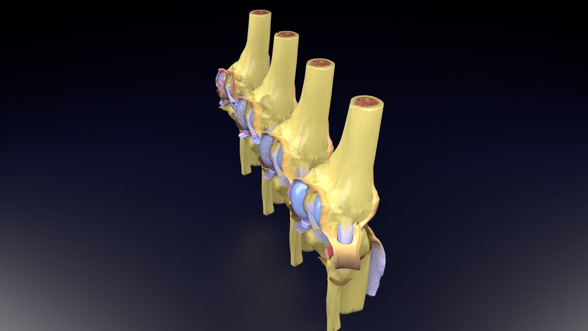 Osteoarthritis stages 3D model_46