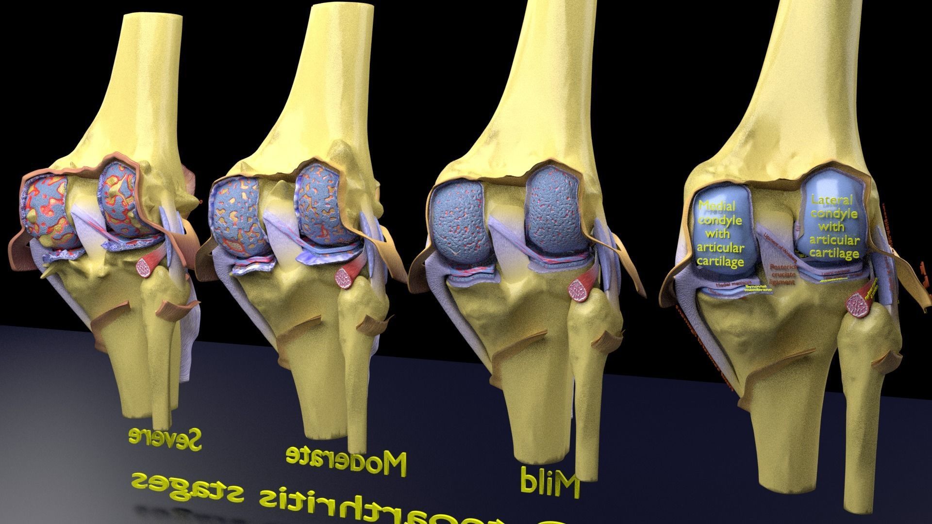 Osteoarthritis stages 3D model_20