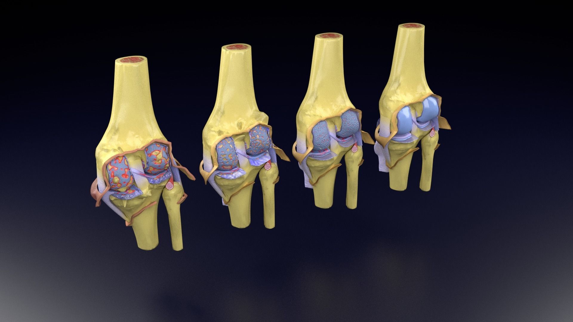 Osteoarthritis stages 3D model_60