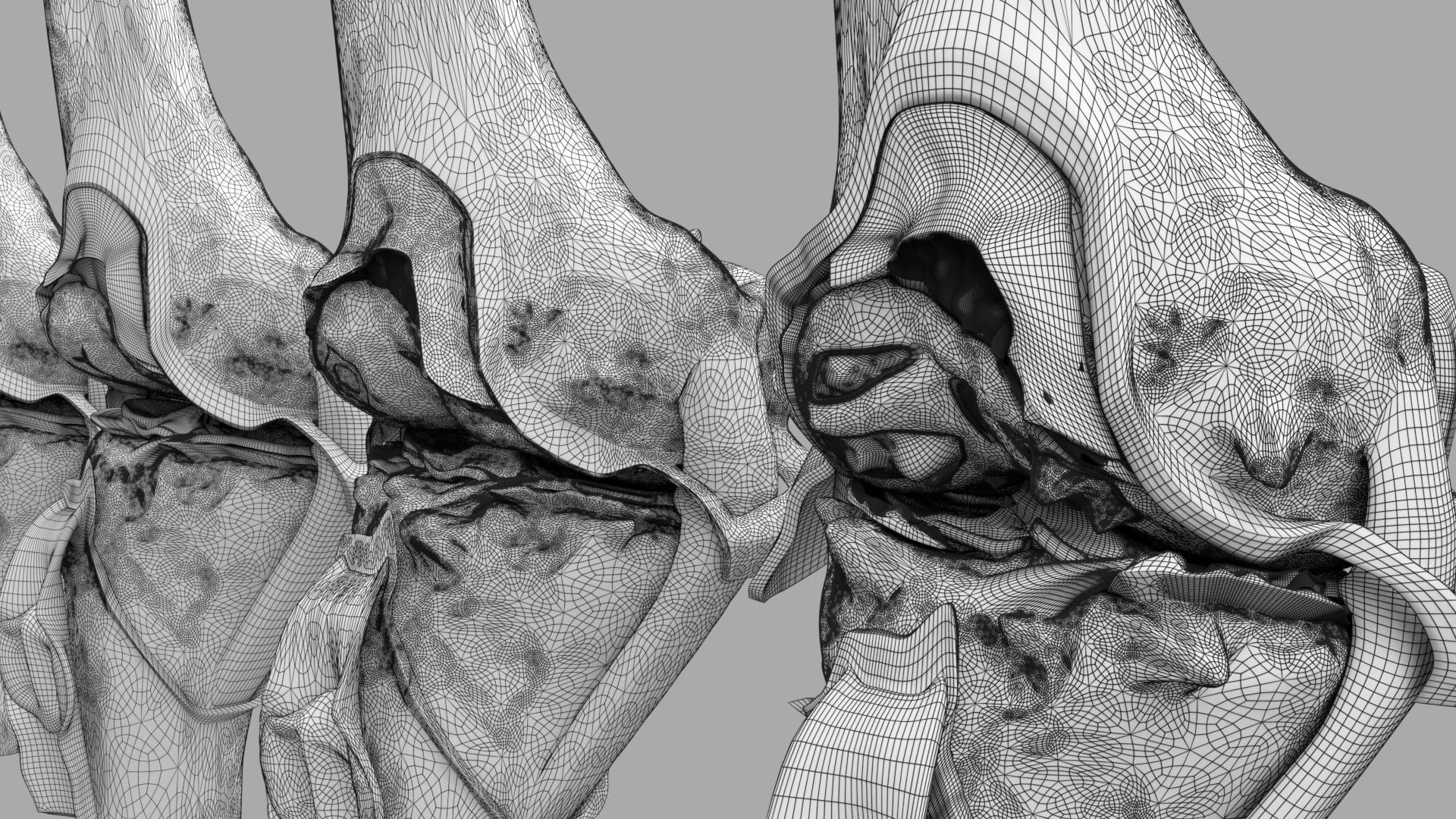 Osteoarthritis stages 3D model_35