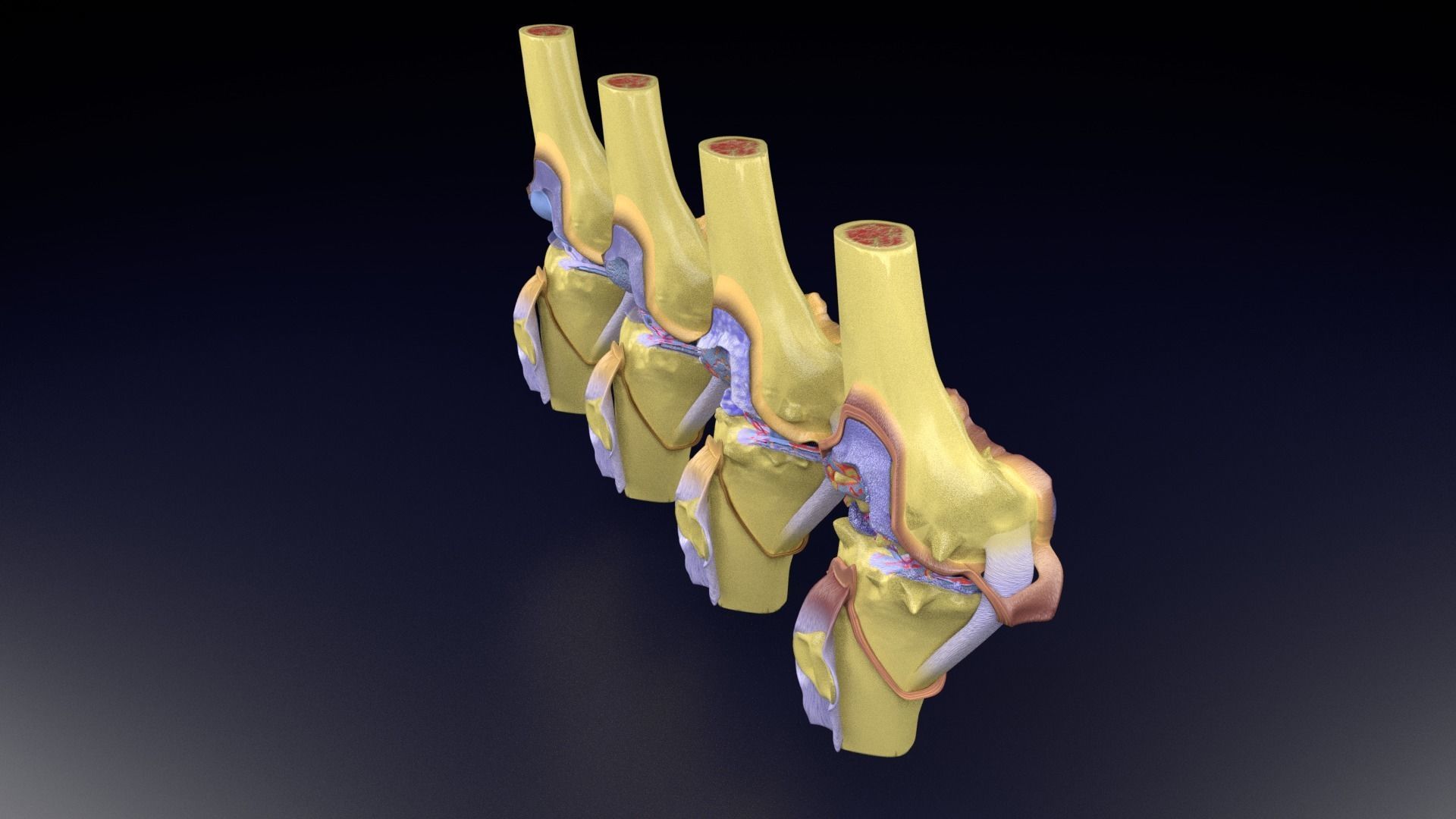 Osteoarthritis stages 3D model_77