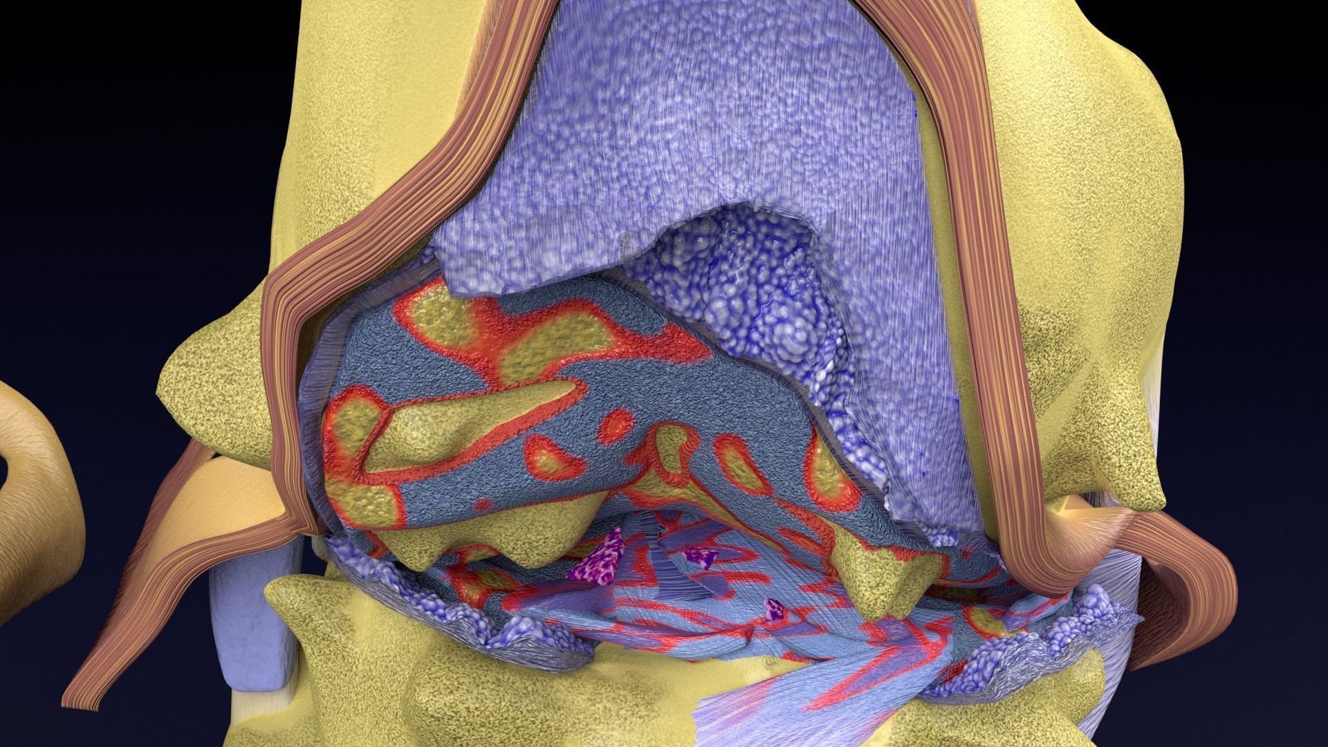 Osteoarthritis stages 3D model_15
