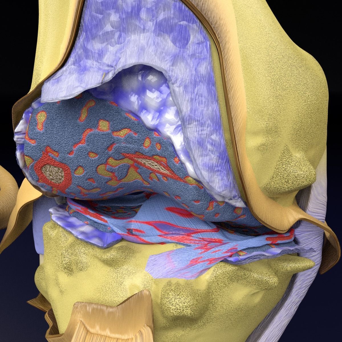 Osteoarthritis stages 3D model_9