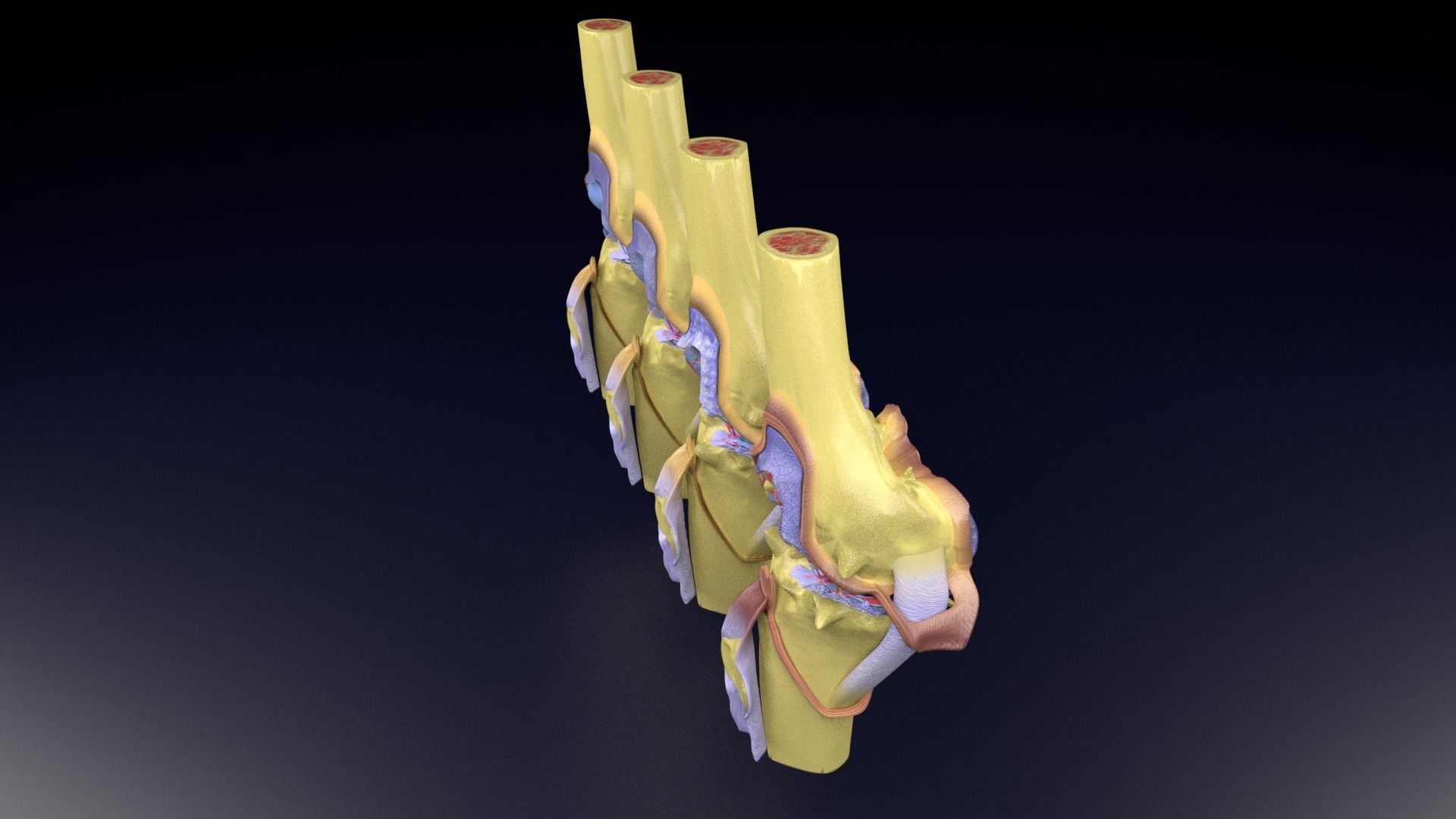Osteoarthritis stages 3D model_76