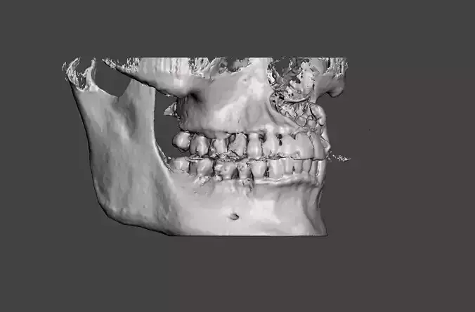Left Maxillary Cystic Lesion with Impacted Supernumerary Tooth