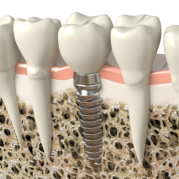 Dental implant 3D model_2