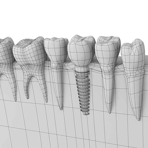 Dental implant 3D model_4