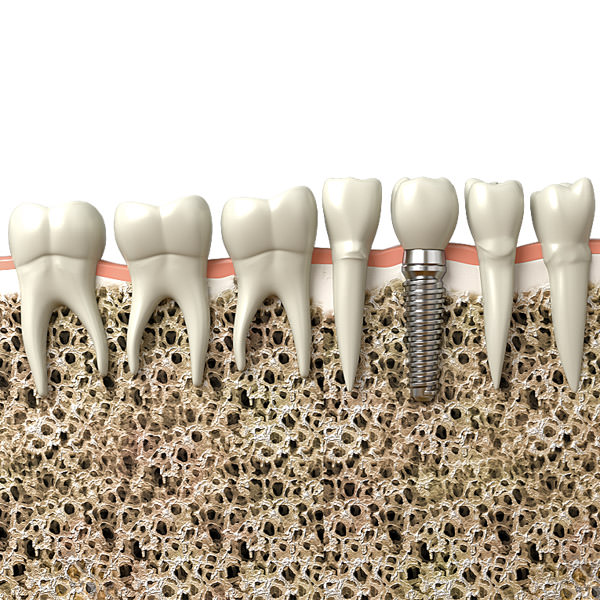 Dental implant 3D model_1