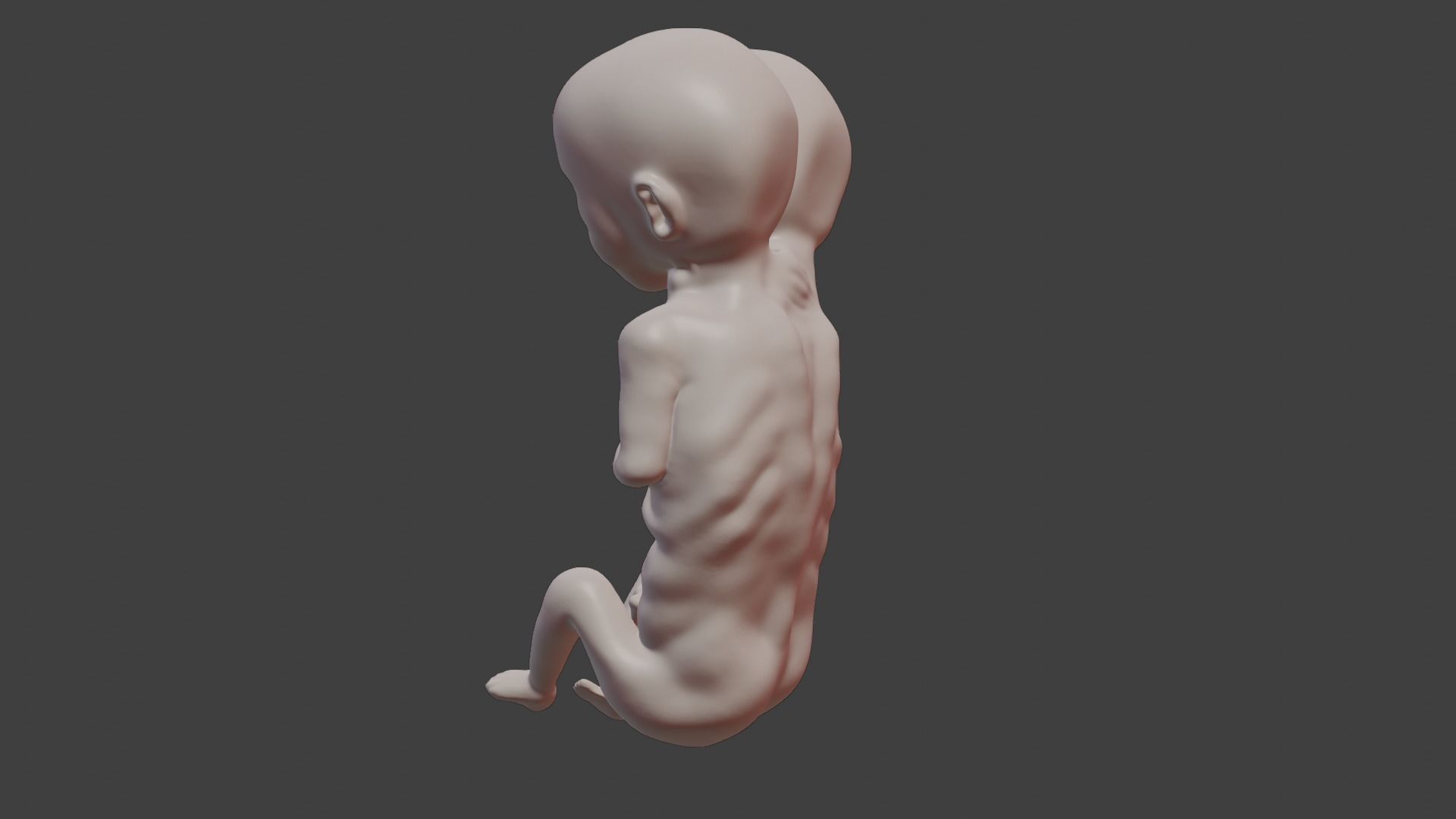 Siamese Twin Fetus 3D print model_4