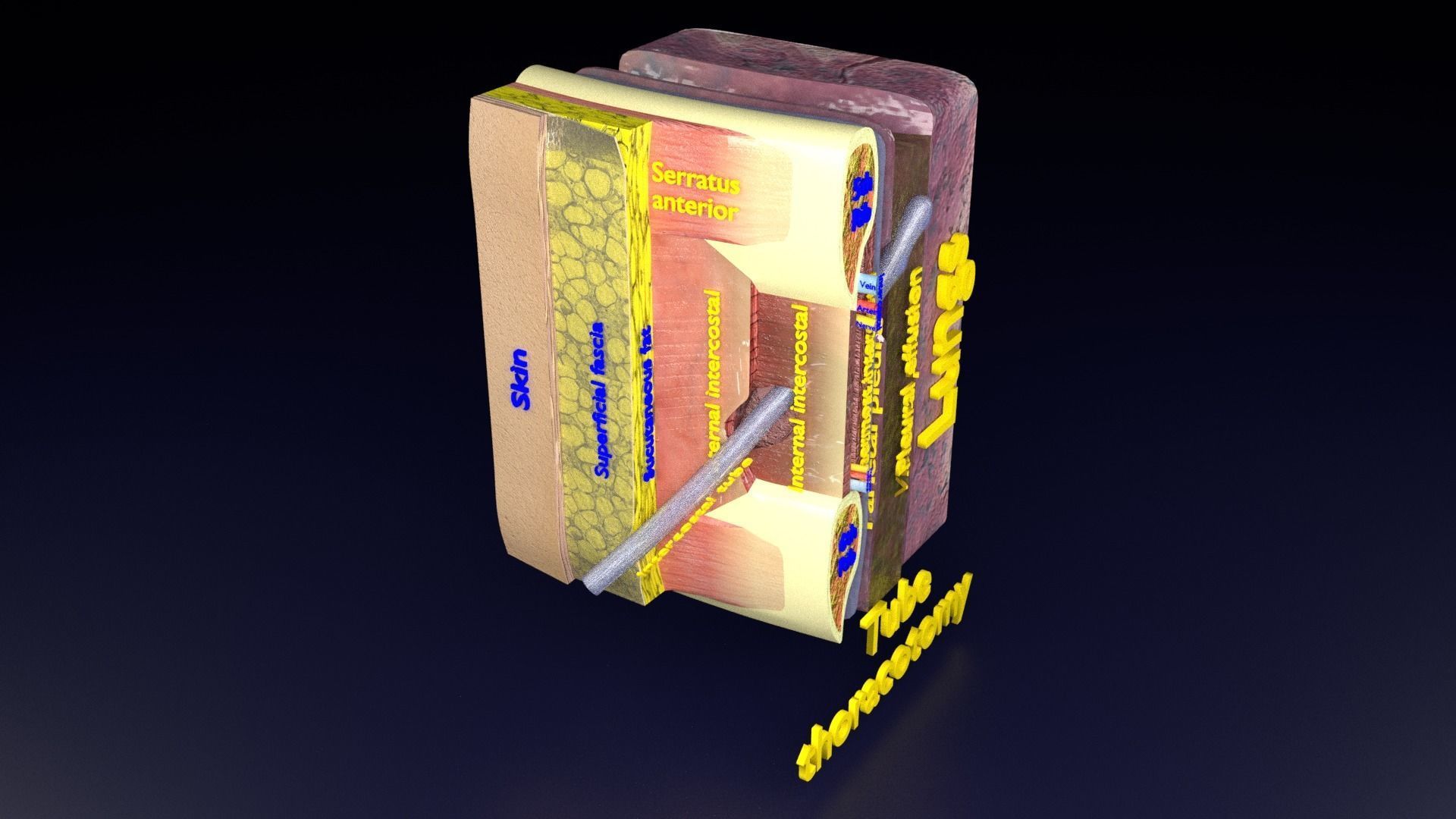 thorax thoracotomy thoracocentesis intercostal nerve block 3D model_50