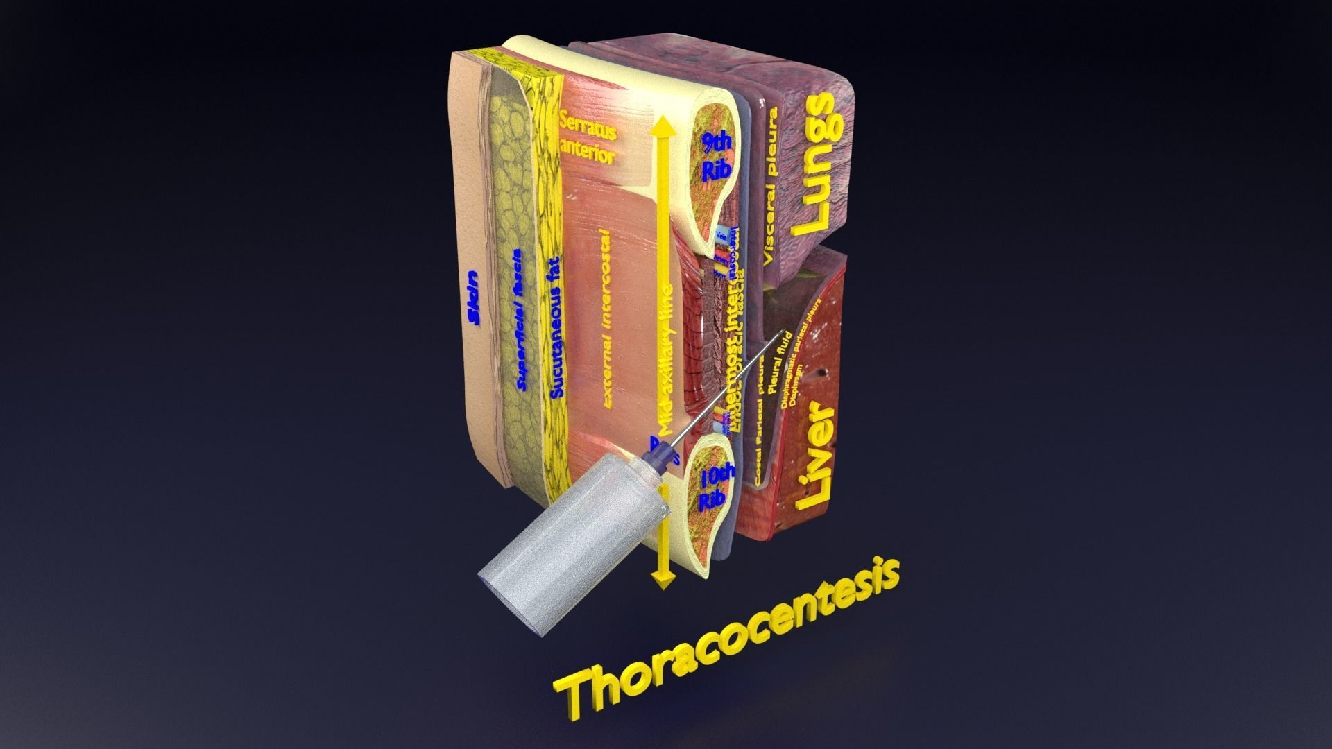 thorax thoracotomy thoracocentesis intercostal nerve block 3D model_76