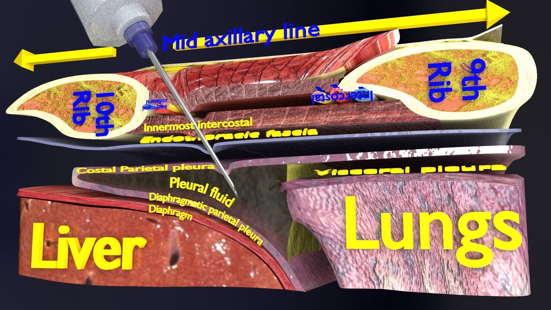thorax thoracotomy thoracocentesis intercostal nerve block 3D model_19