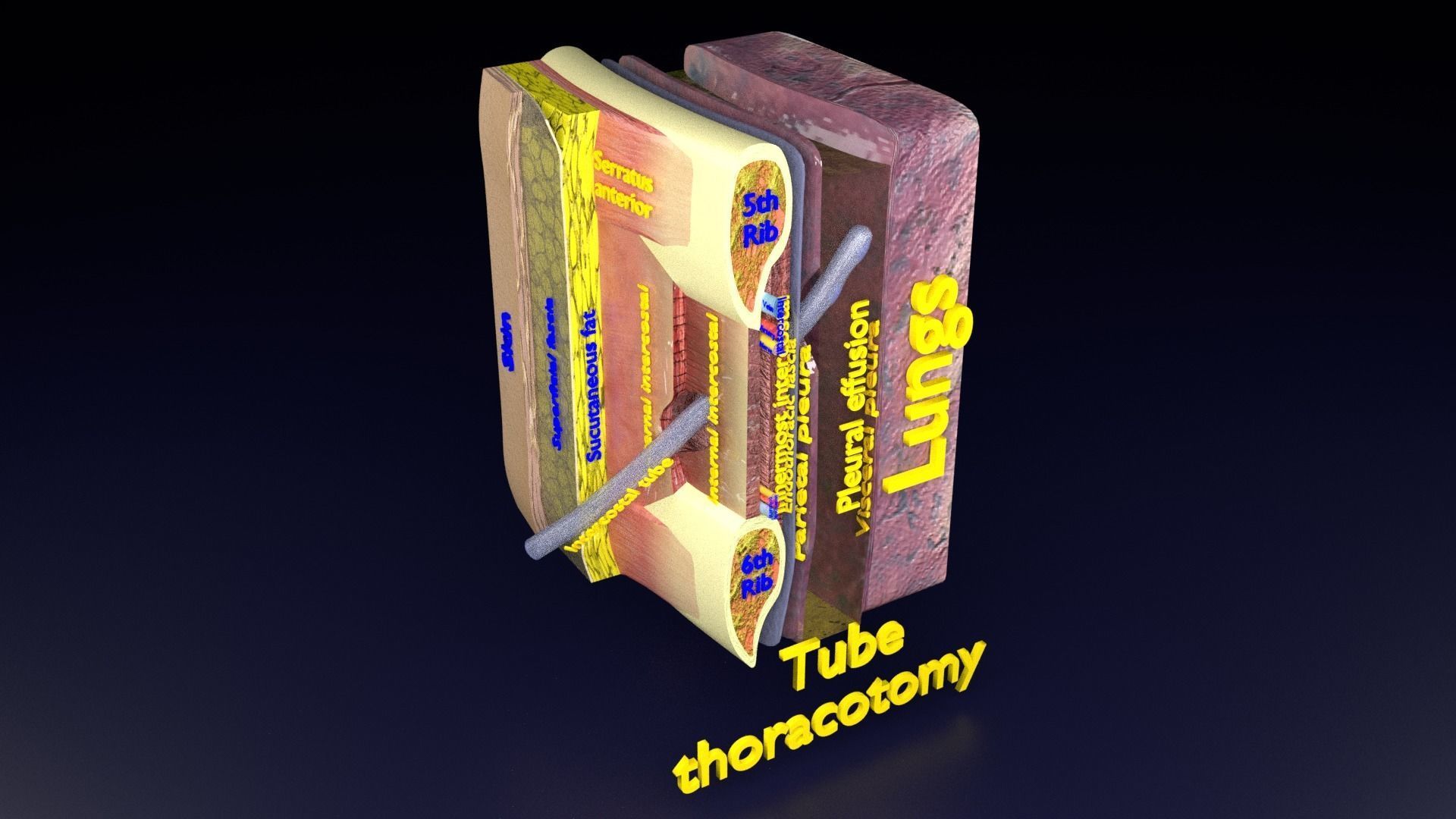 thorax thoracotomy thoracocentesis intercostal nerve block 3D model_47