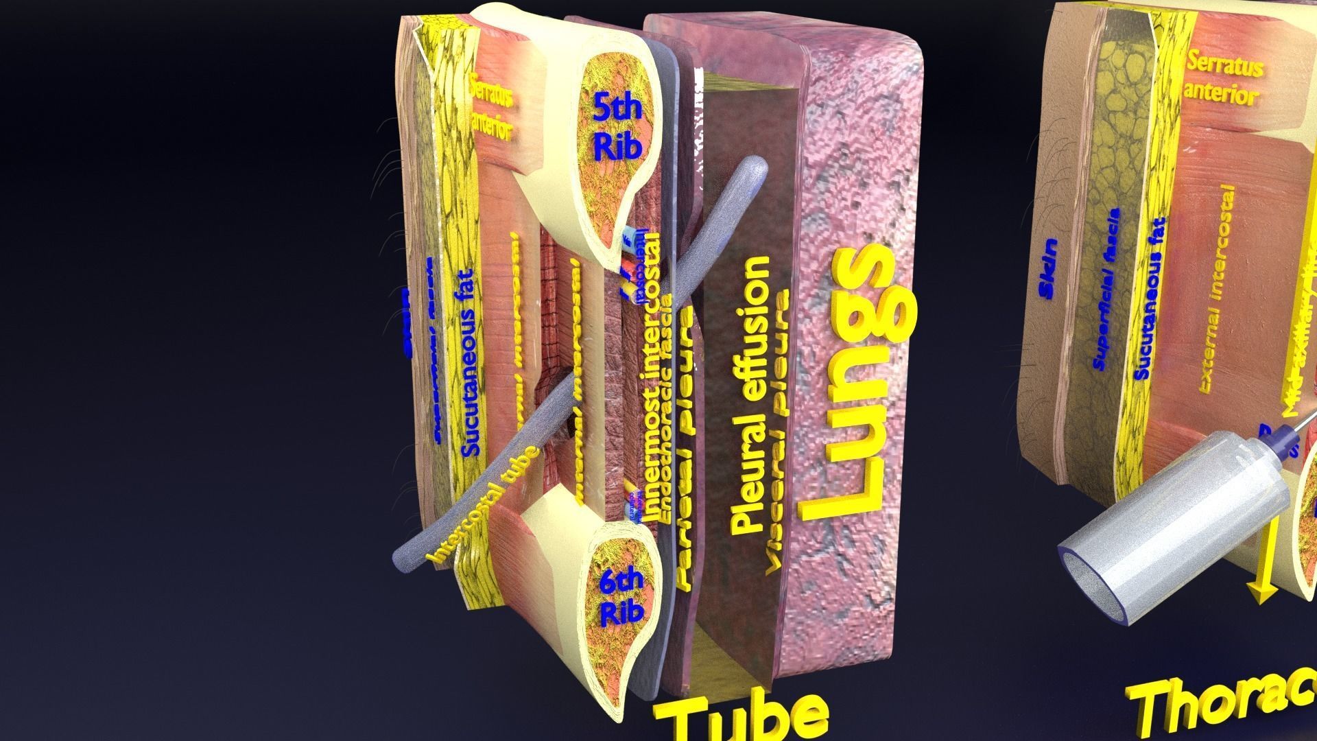 thorax thoracotomy thoracocentesis intercostal nerve block 3D model_31