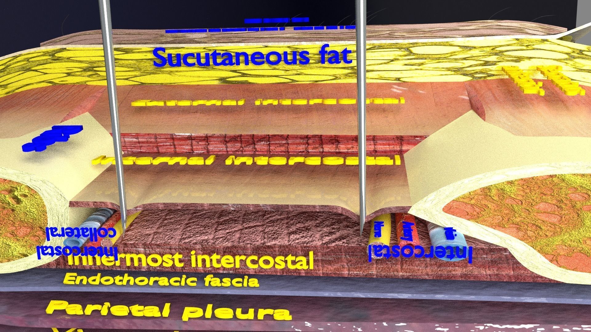 thorax thoracotomy thoracocentesis intercostal nerve block 3D model_27