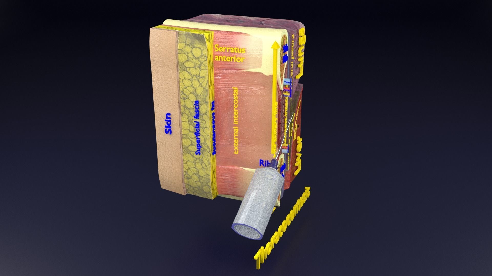 thorax thoracotomy thoracocentesis intercostal nerve block 3D model_65