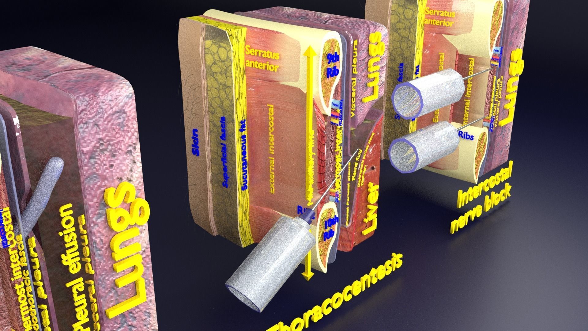 thorax thoracotomy thoracocentesis intercostal nerve block 3D model_3