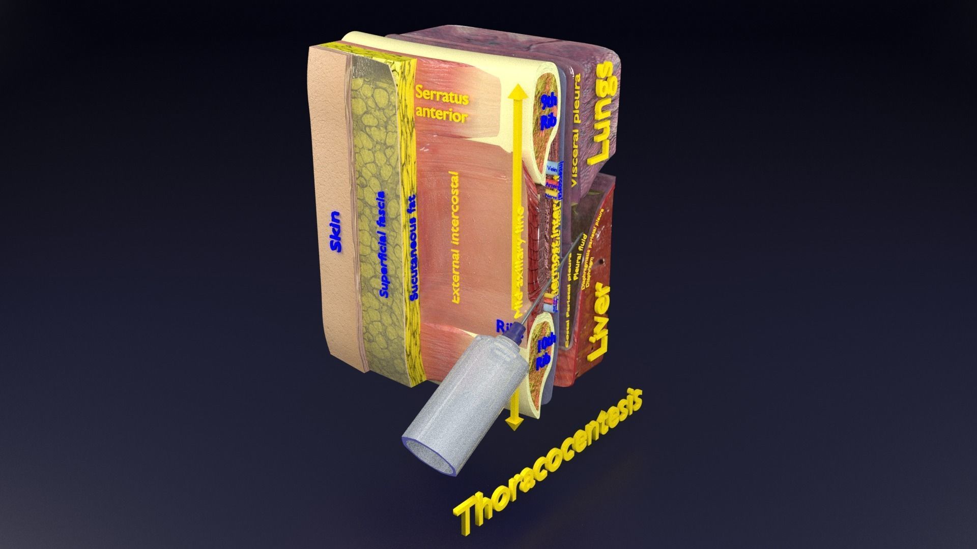 thorax thoracotomy thoracocentesis intercostal nerve block 3D model_74