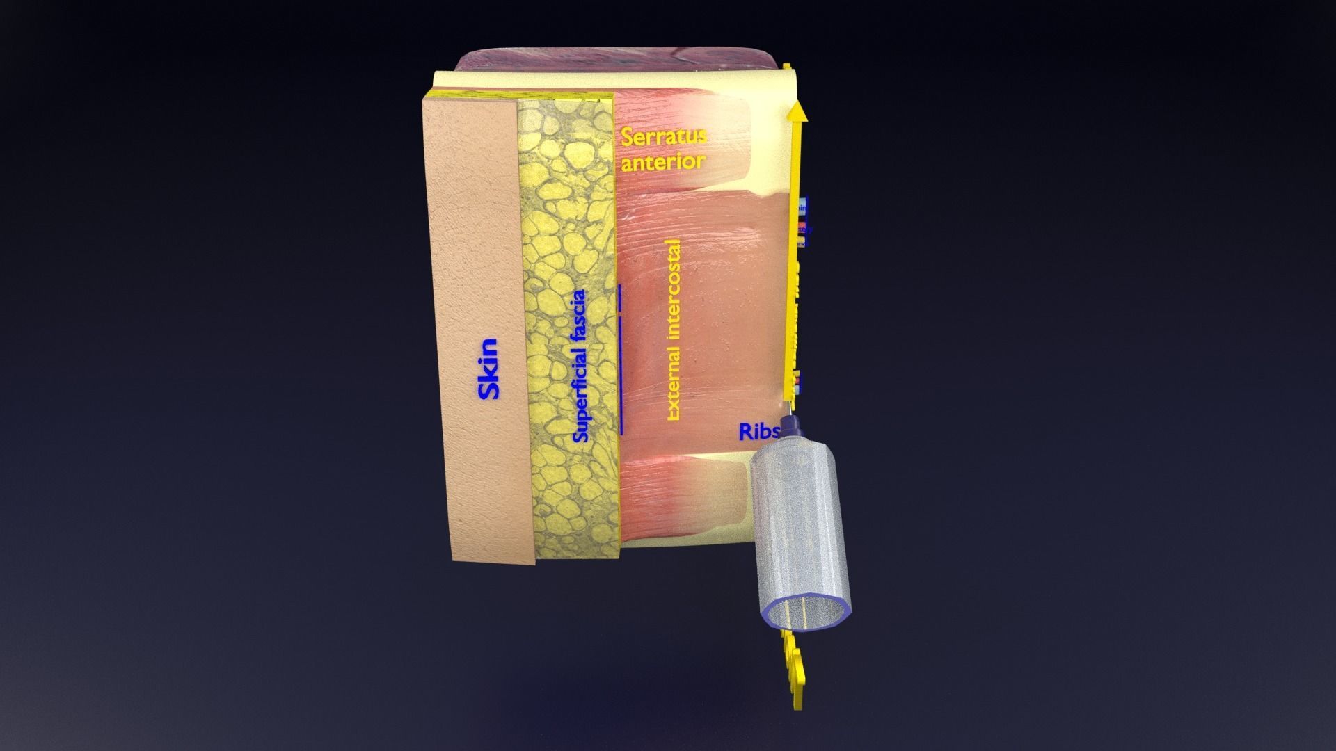 thorax thoracotomy thoracocentesis intercostal nerve block 3D model_71
