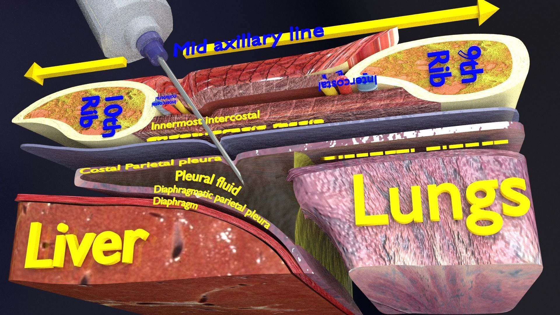 thorax thoracotomy thoracocentesis intercostal nerve block 3D model_21