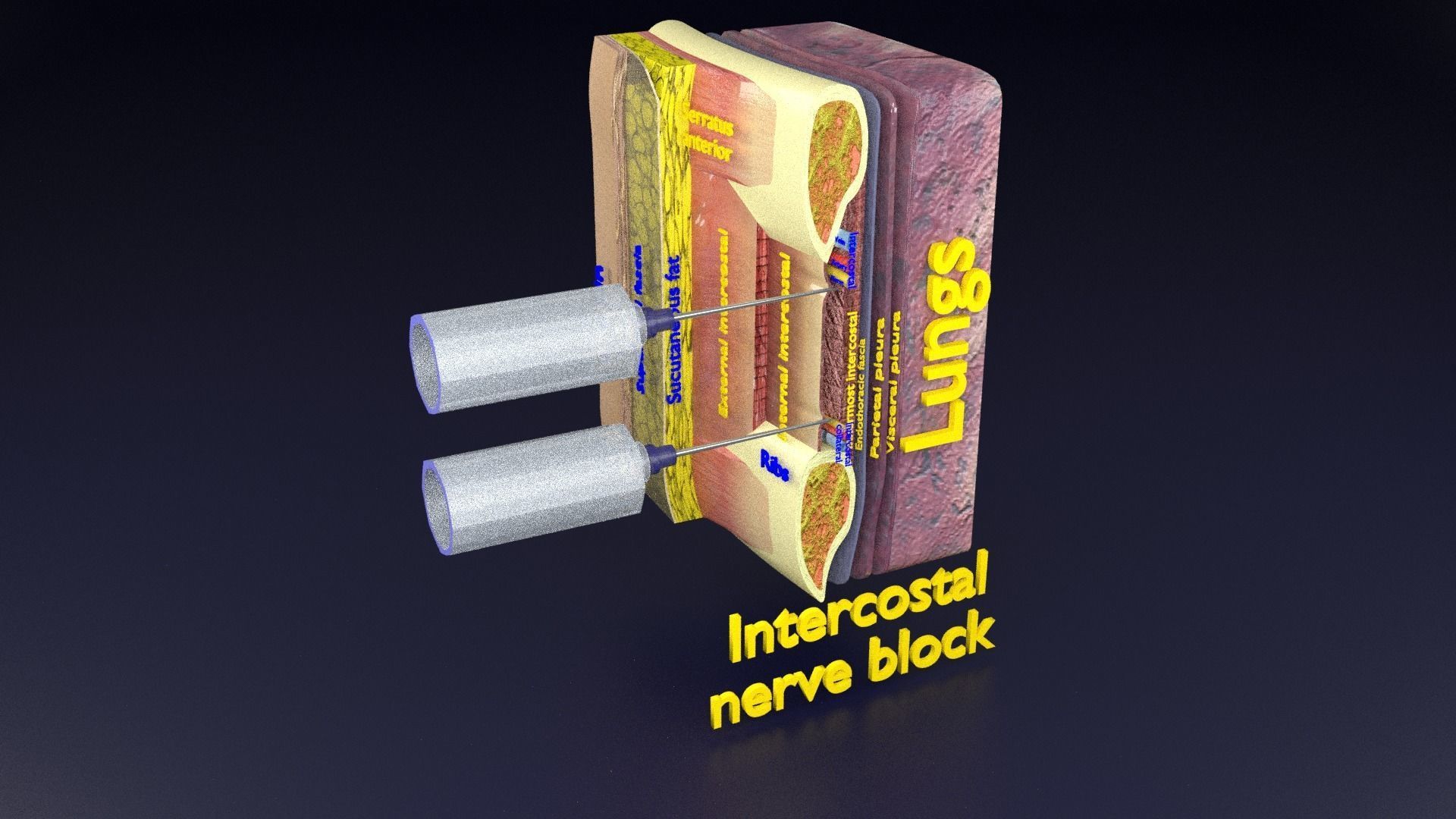 thorax thoracotomy thoracocentesis intercostal nerve block 3D model_87