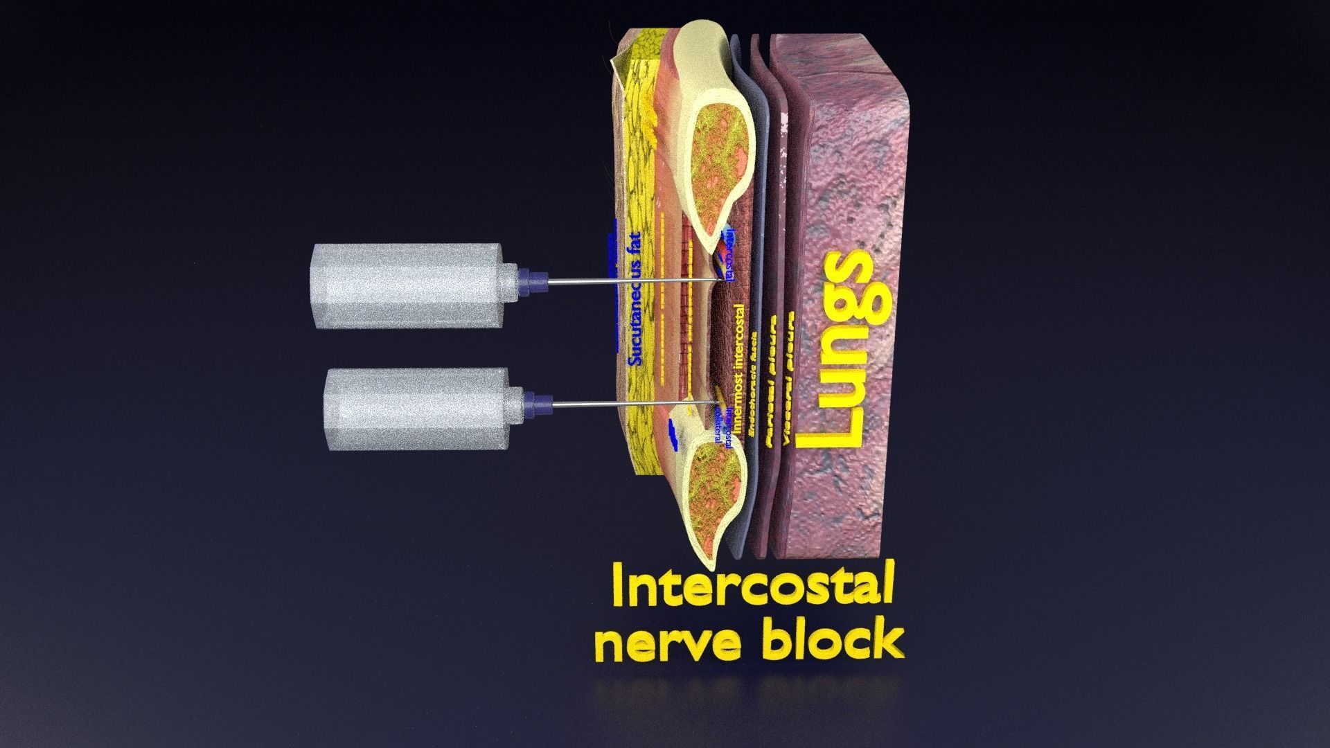 thorax thoracotomy thoracocentesis intercostal nerve block 3D model_80