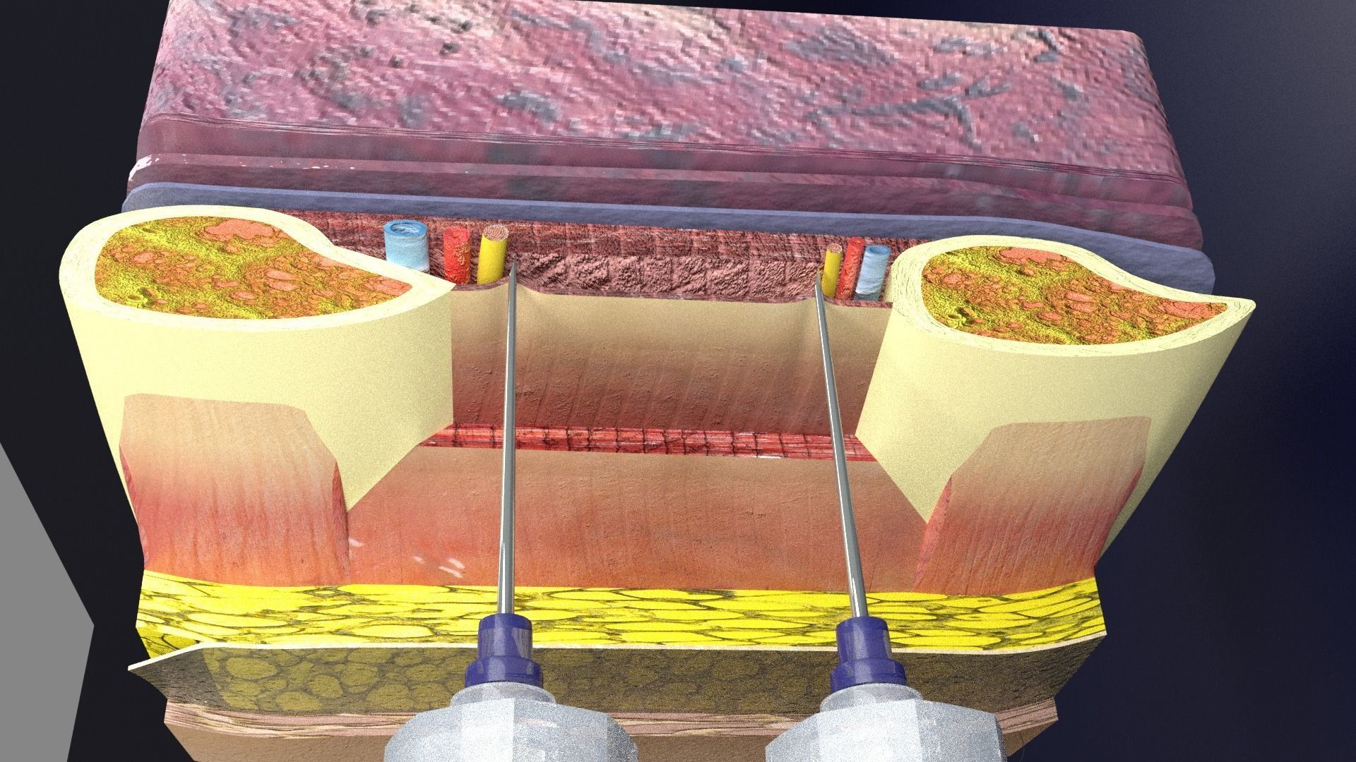 thorax thoracotomy thoracocentesis intercostal nerve block 3D model_29