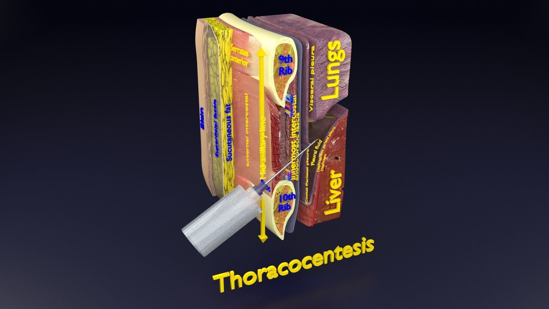 thorax thoracotomy thoracocentesis intercostal nerve block 3D model_73