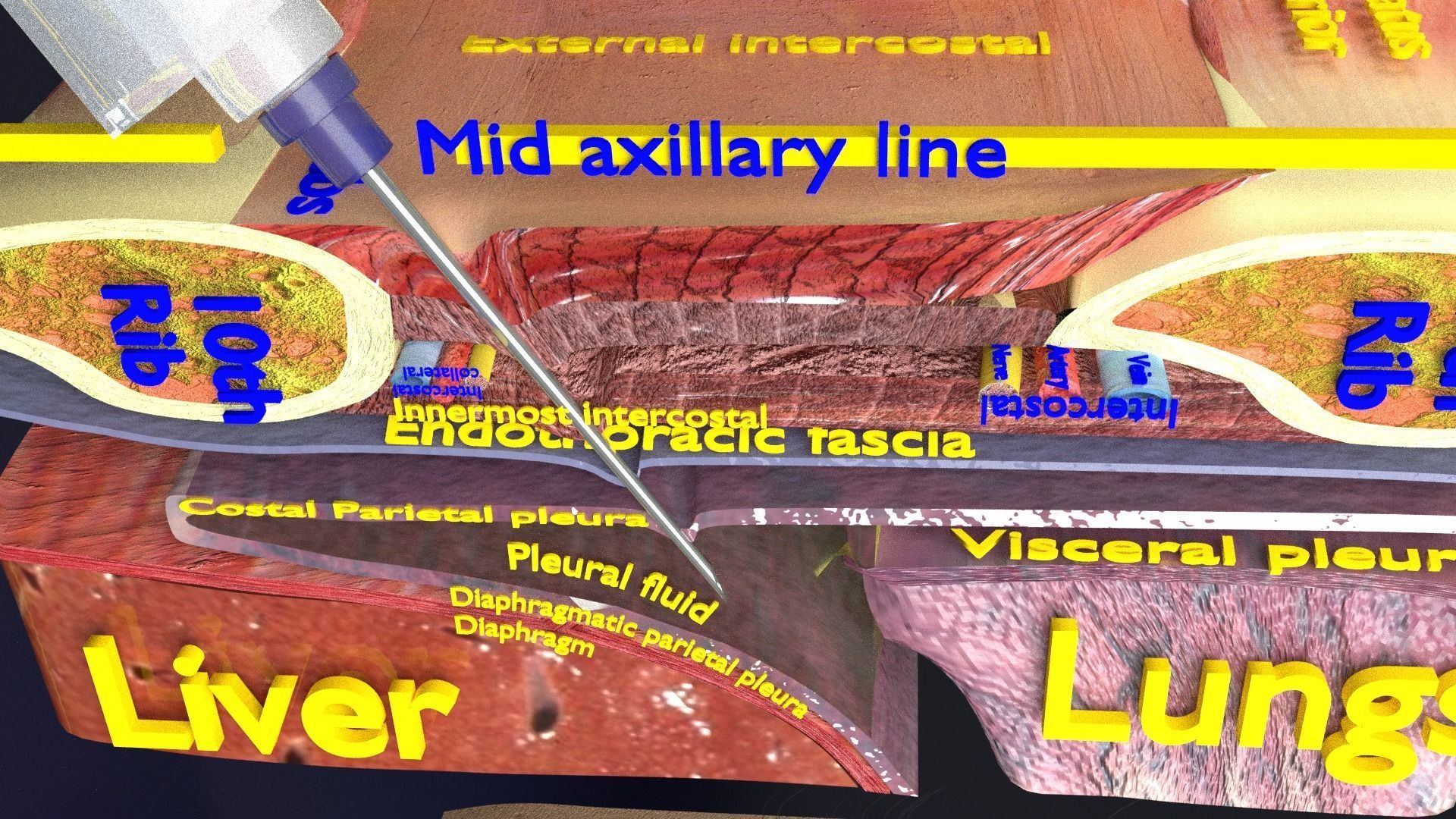 thorax thoracotomy thoracocentesis intercostal nerve block 3D model_22