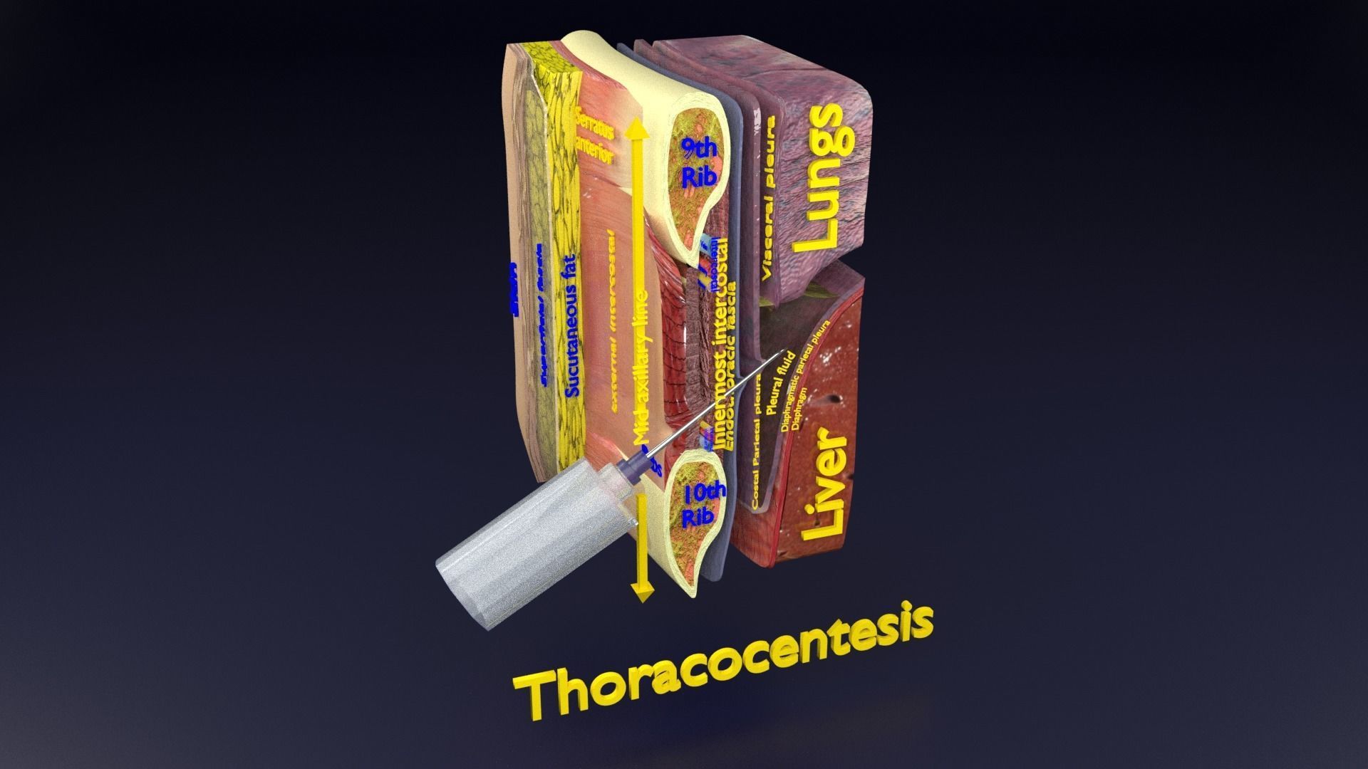 thorax thoracotomy thoracocentesis intercostal nerve block 3D model_70