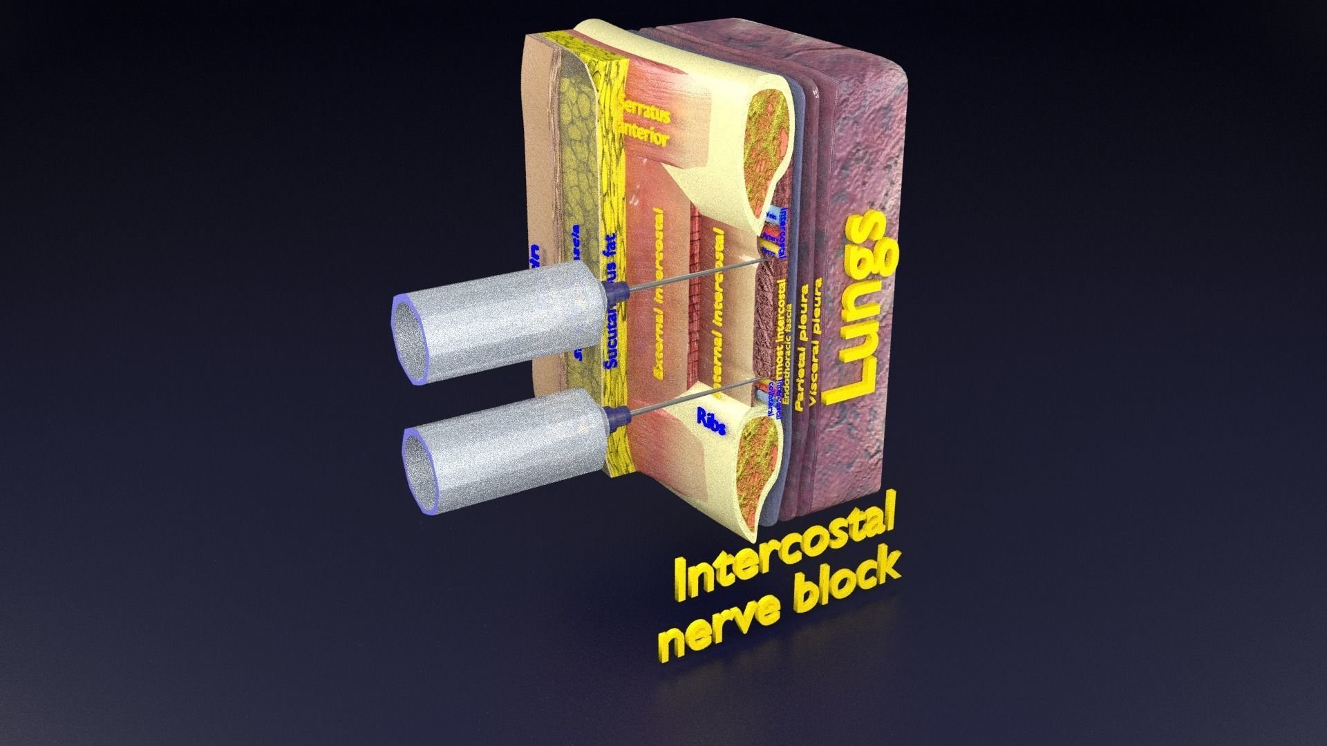 thorax thoracotomy thoracocentesis intercostal nerve block 3D model_86