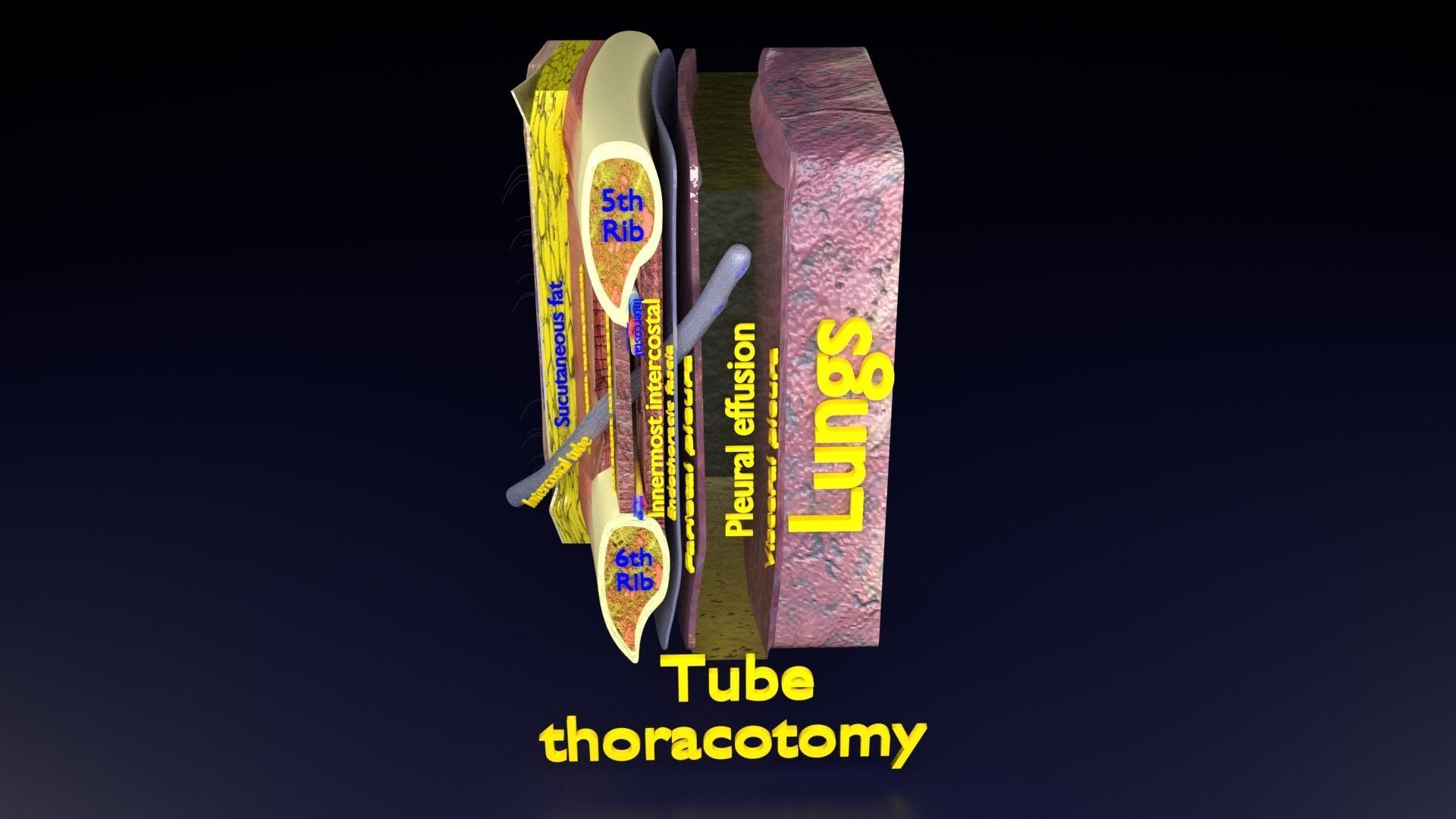 thorax thoracotomy thoracocentesis intercostal nerve block 3D model_42