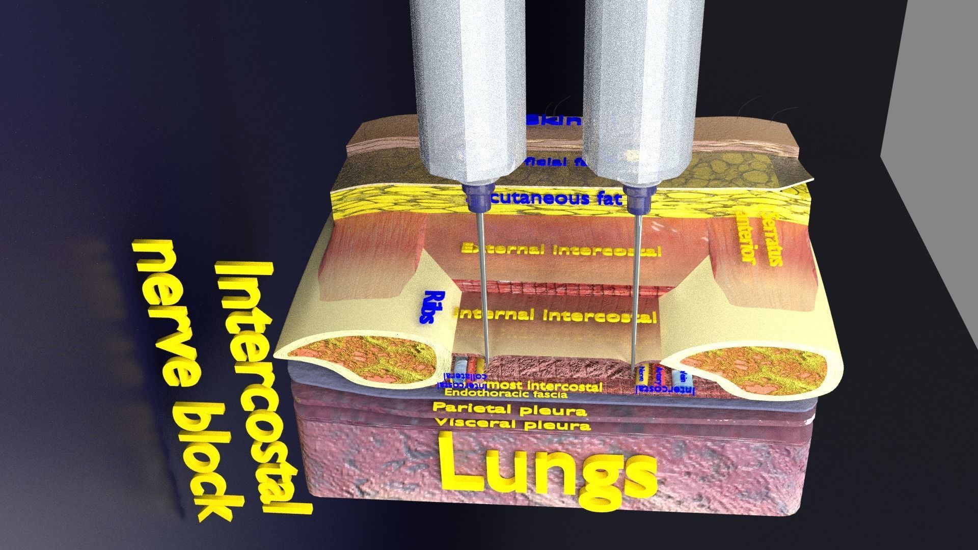 thorax thoracotomy thoracocentesis intercostal nerve block 3D model_23
