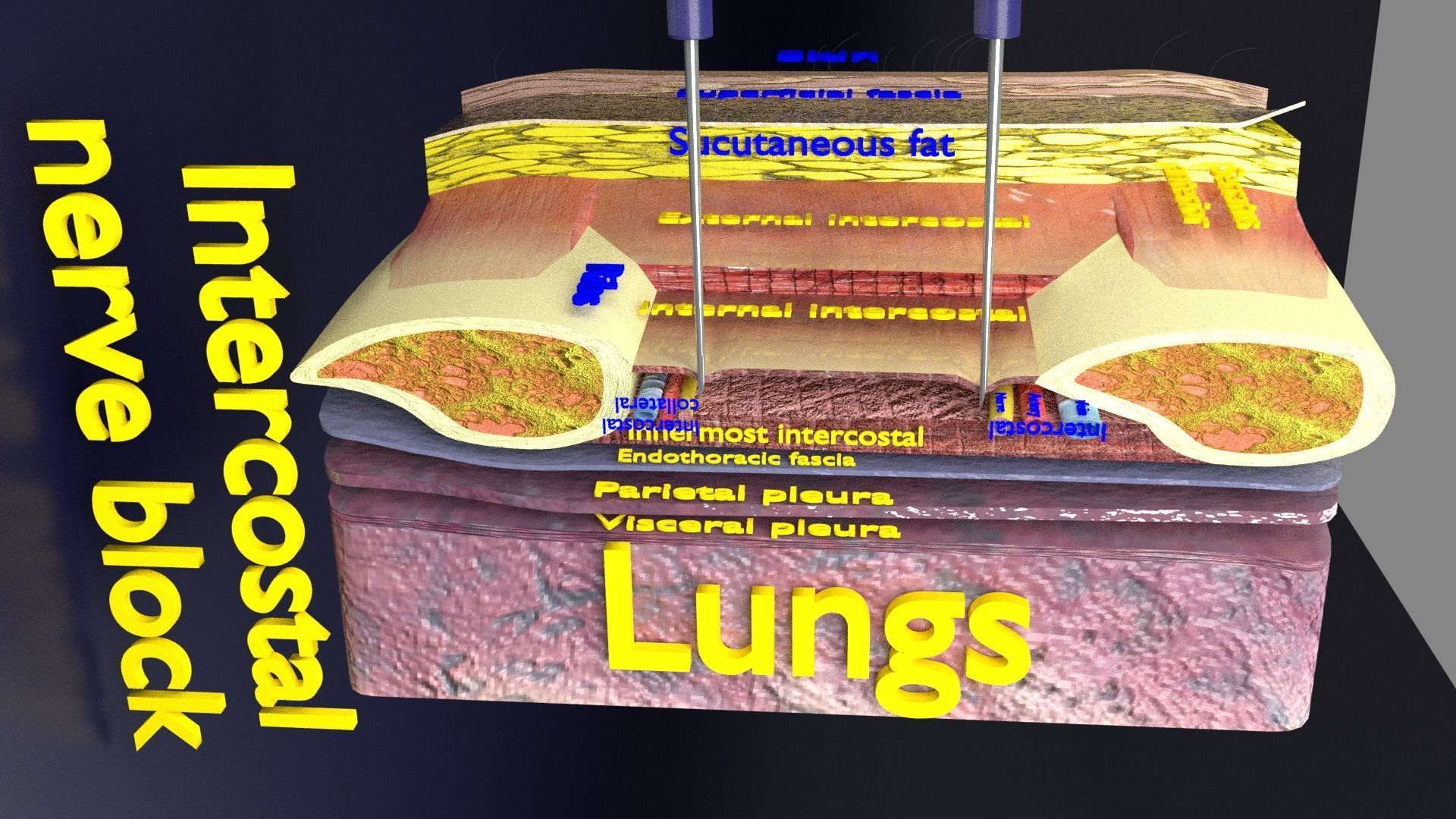 thorax thoracotomy thoracocentesis intercostal nerve block 3D model_25