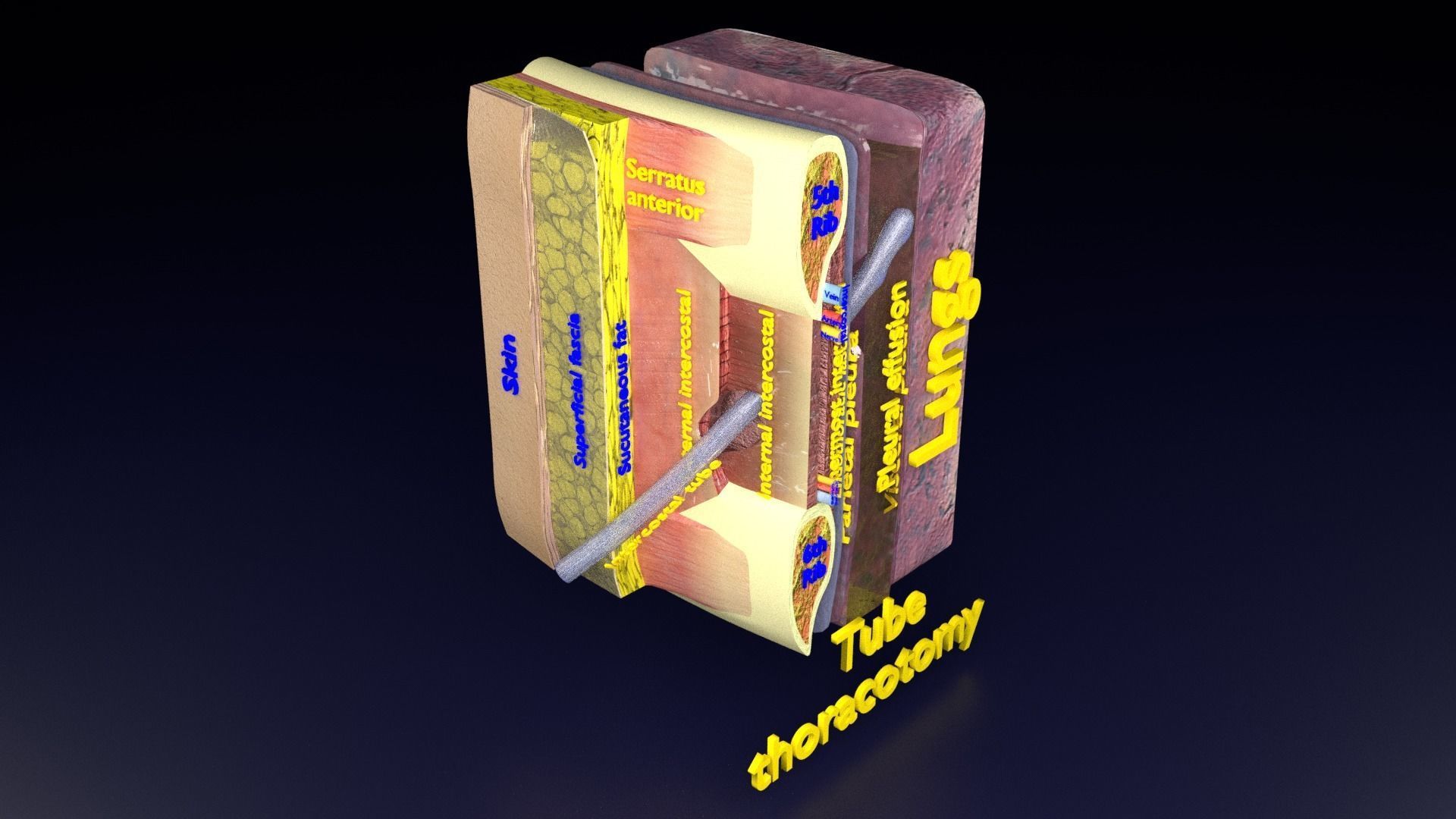 thorax thoracotomy thoracocentesis intercostal nerve block 3D model_56