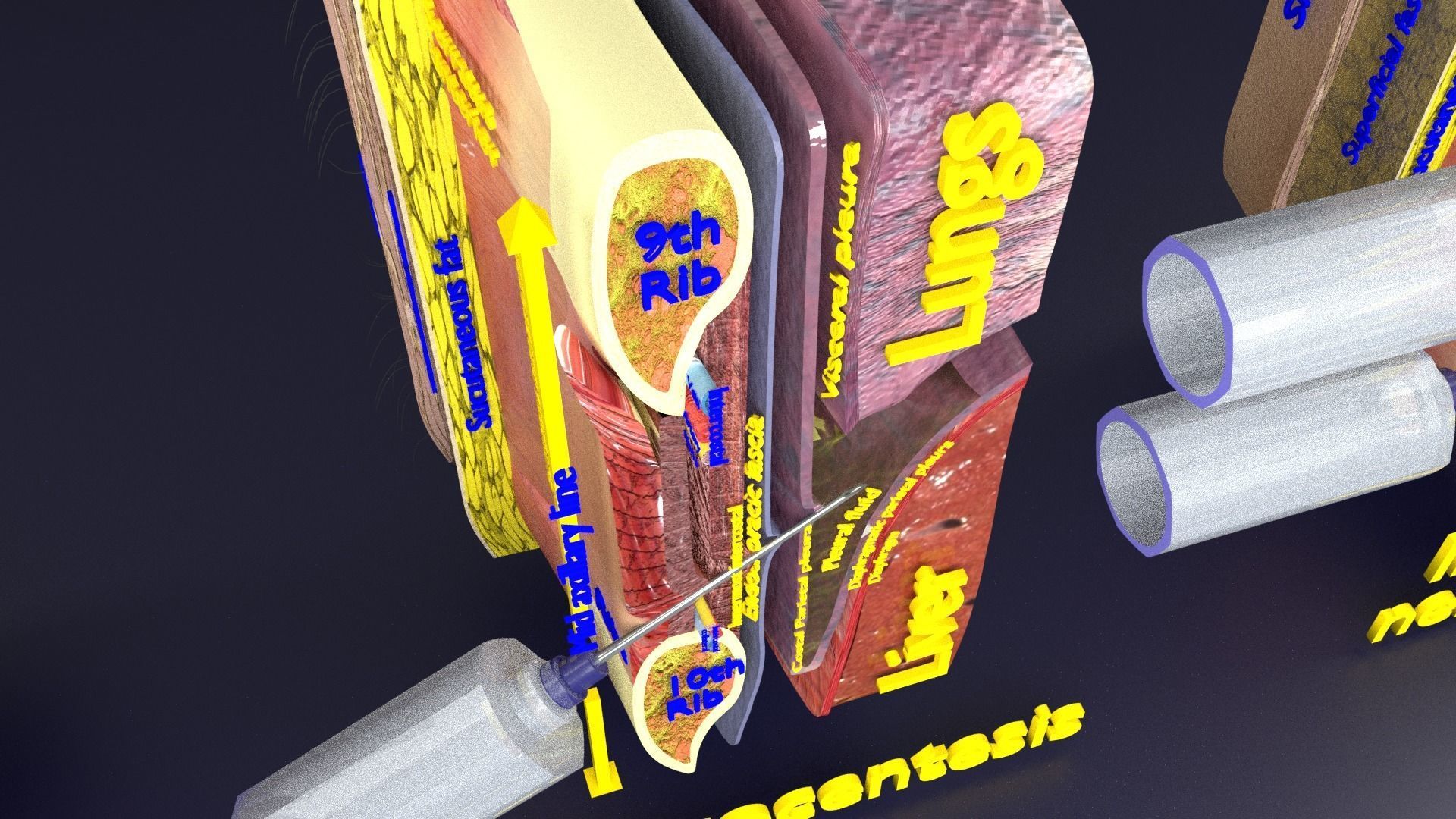 thorax thoracotomy thoracocentesis intercostal nerve block 3D model_13
