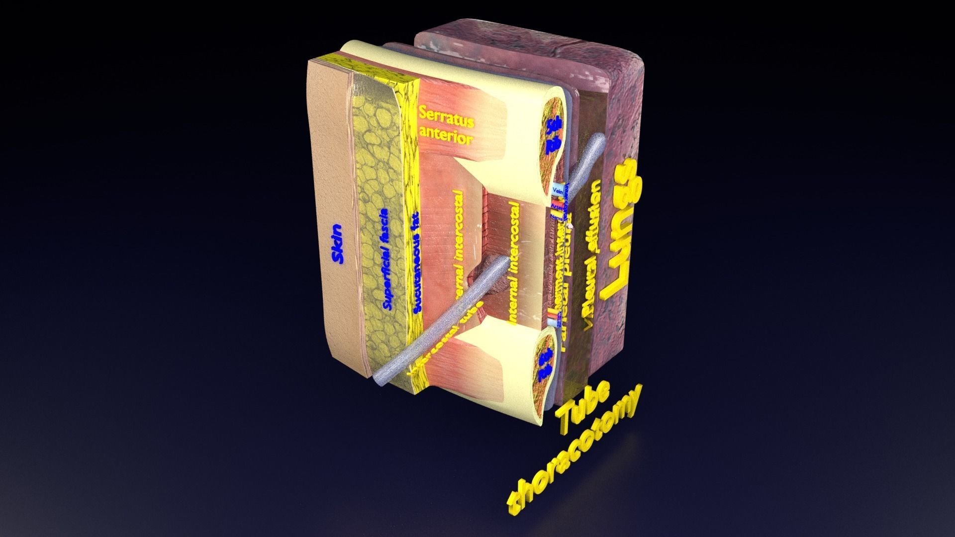 thorax thoracotomy thoracocentesis intercostal nerve block 3D model_57