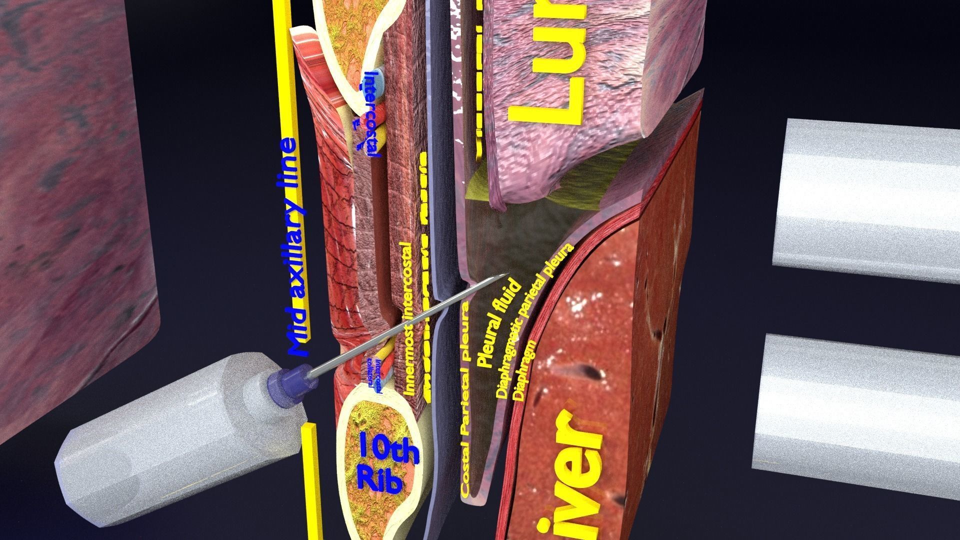 thorax thoracotomy thoracocentesis intercostal nerve block 3D model_11