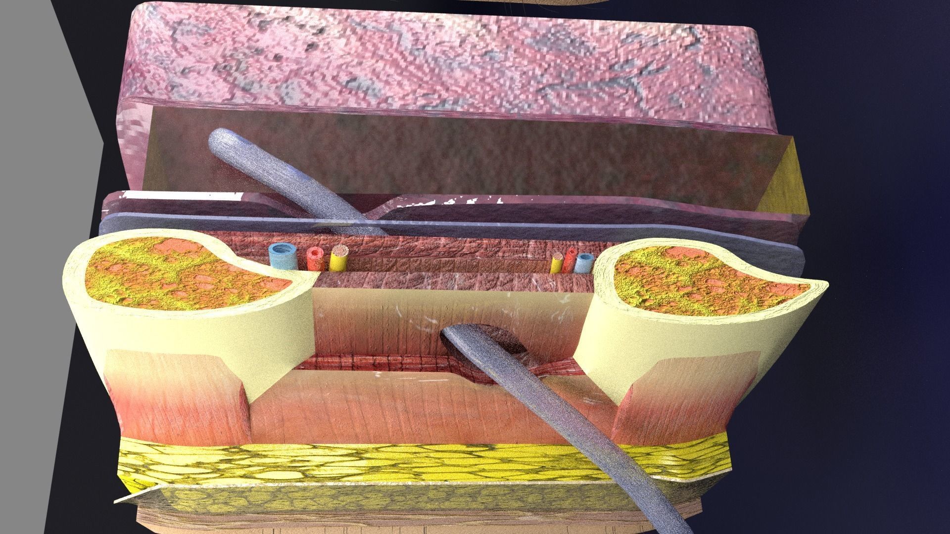 thorax thoracotomy thoracocentesis intercostal nerve block 3D model_30