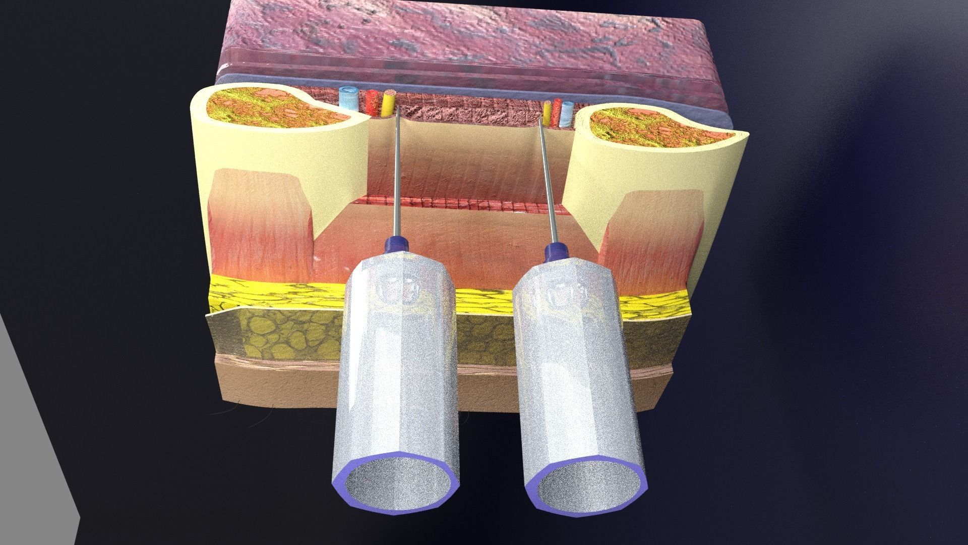 thorax thoracotomy thoracocentesis intercostal nerve block 3D model_4