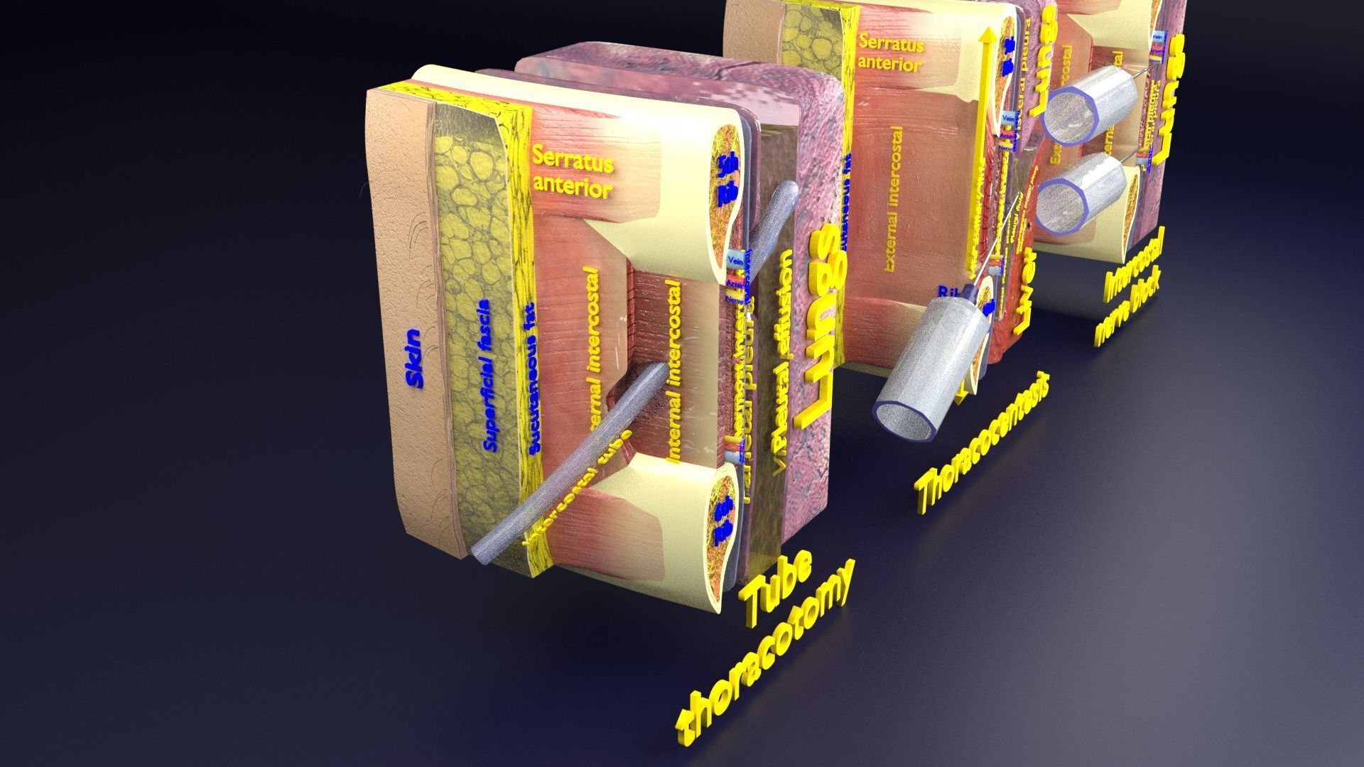 thorax thoracotomy thoracocentesis intercostal nerve block 3D model_32