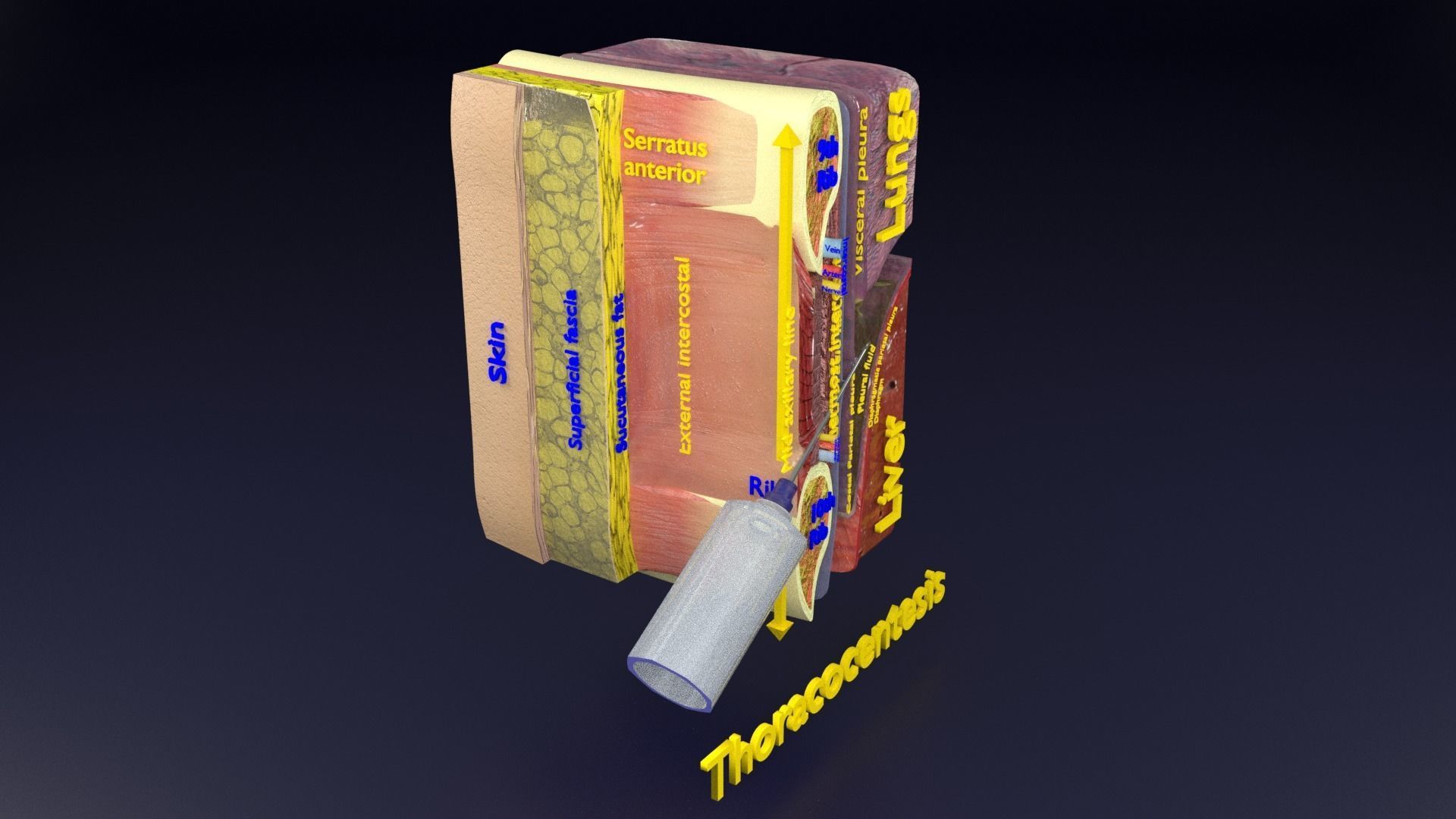 thorax thoracotomy thoracocentesis intercostal nerve block 3D model_62