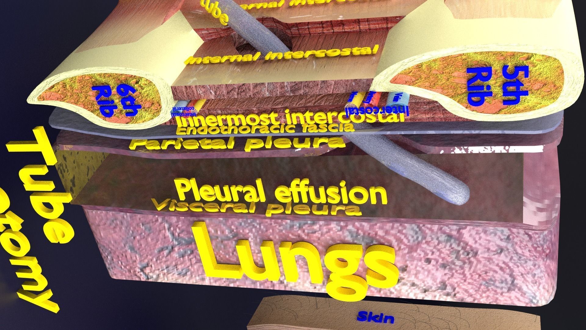 thorax thoracotomy thoracocentesis intercostal nerve block 3D model_35