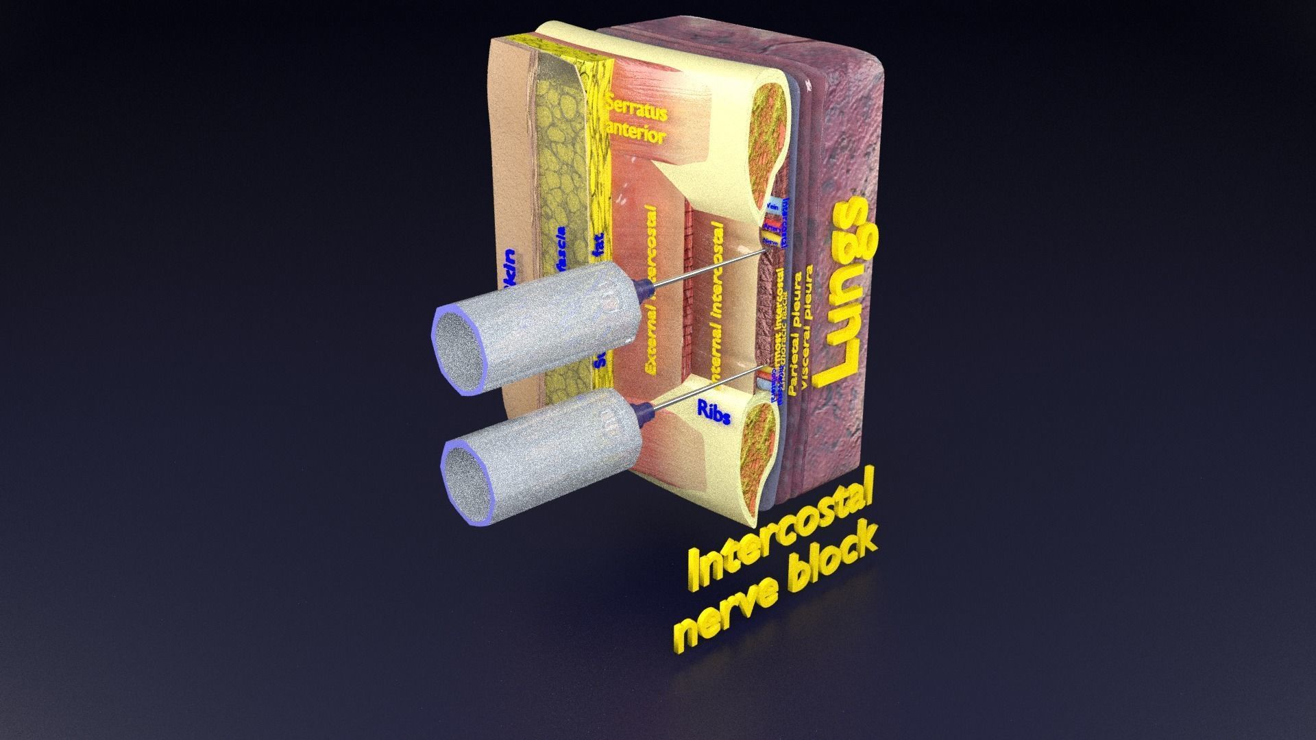 thorax thoracotomy thoracocentesis intercostal nerve block 3D model_97