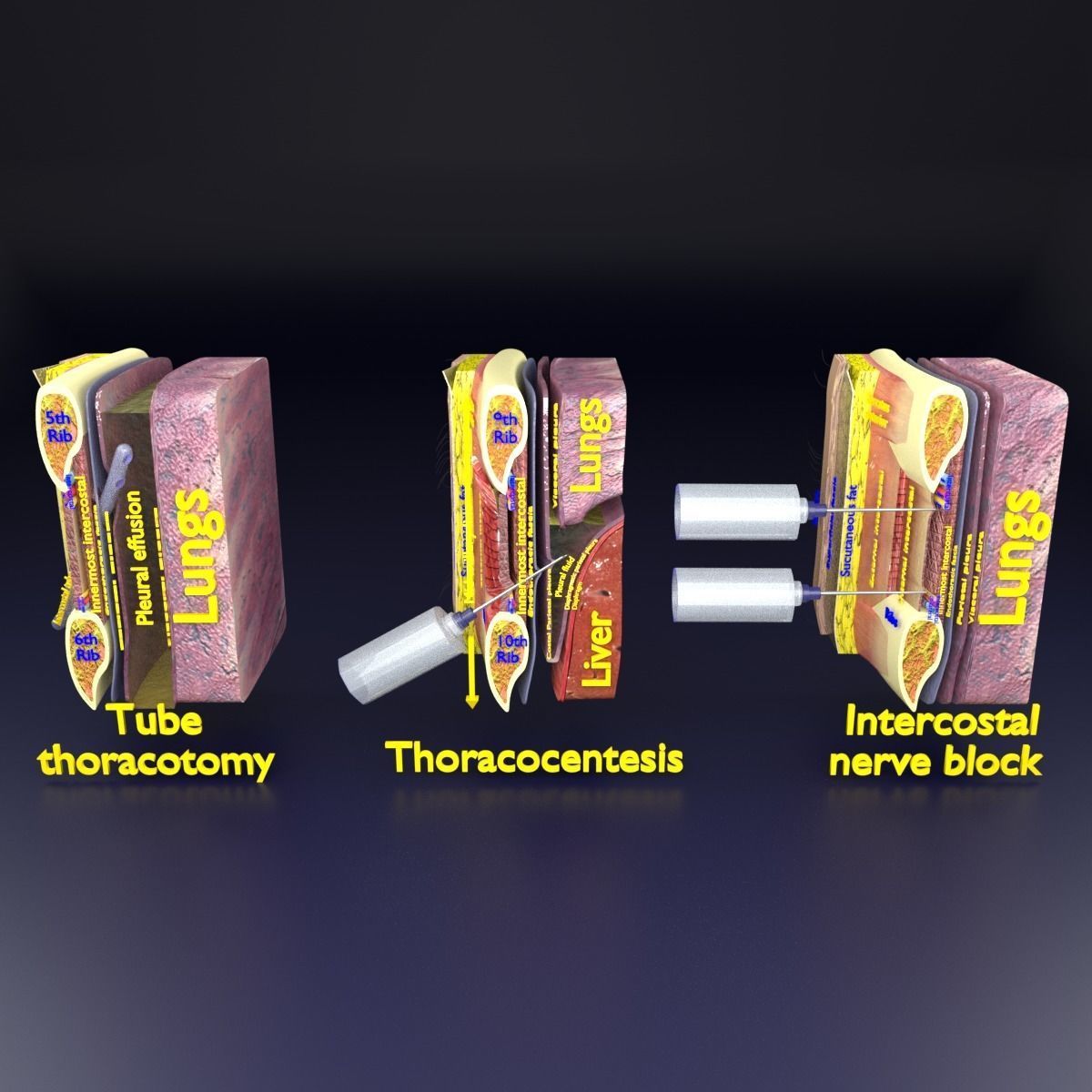 thorax thoracotomy thoracocentesis intercostal nerve block 3D model_24