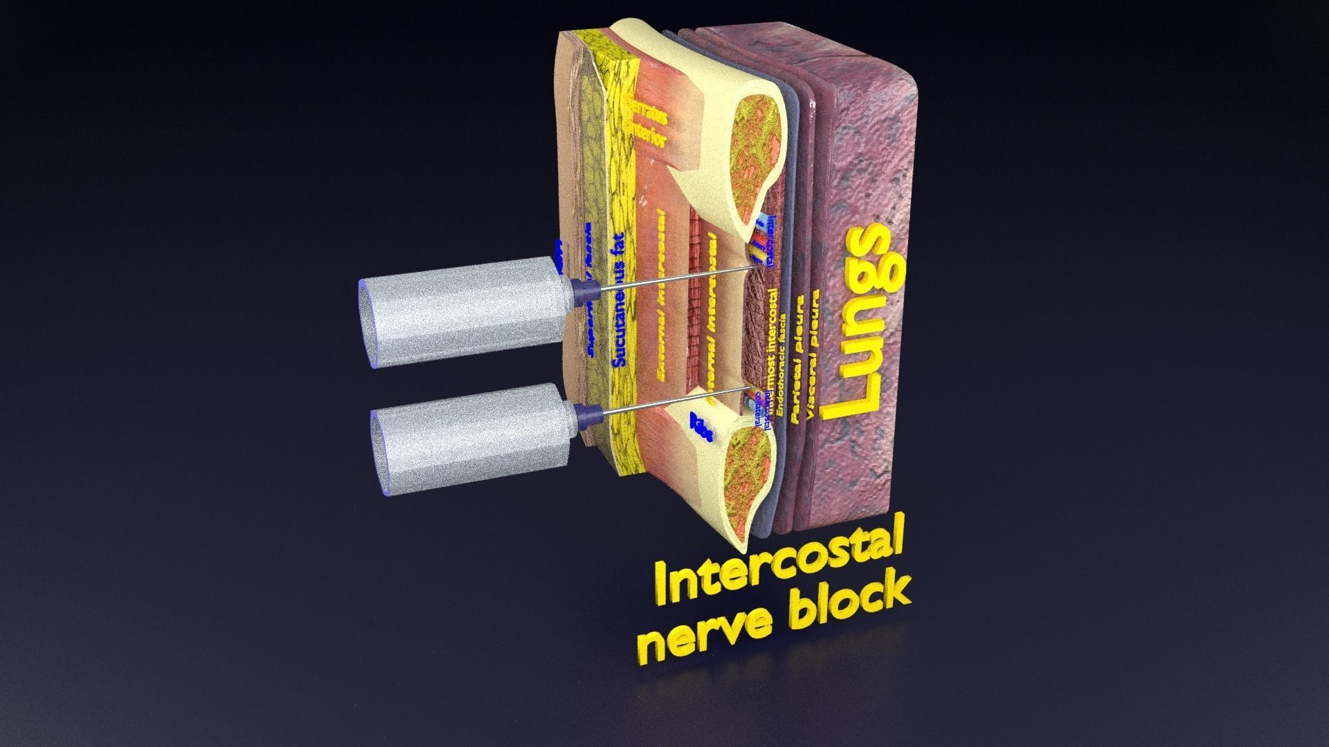 thorax thoracotomy thoracocentesis intercostal nerve block 3D model_89