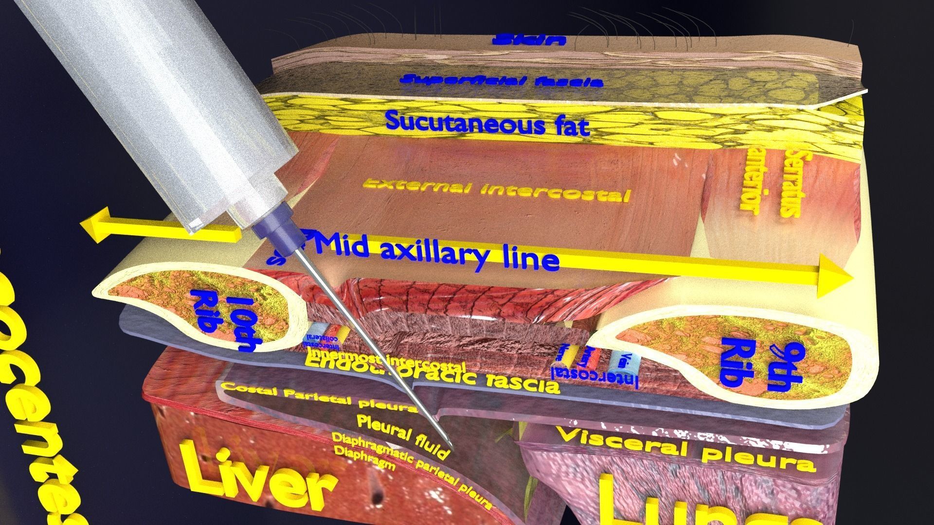 thorax thoracotomy thoracocentesis intercostal nerve block 3D model_15