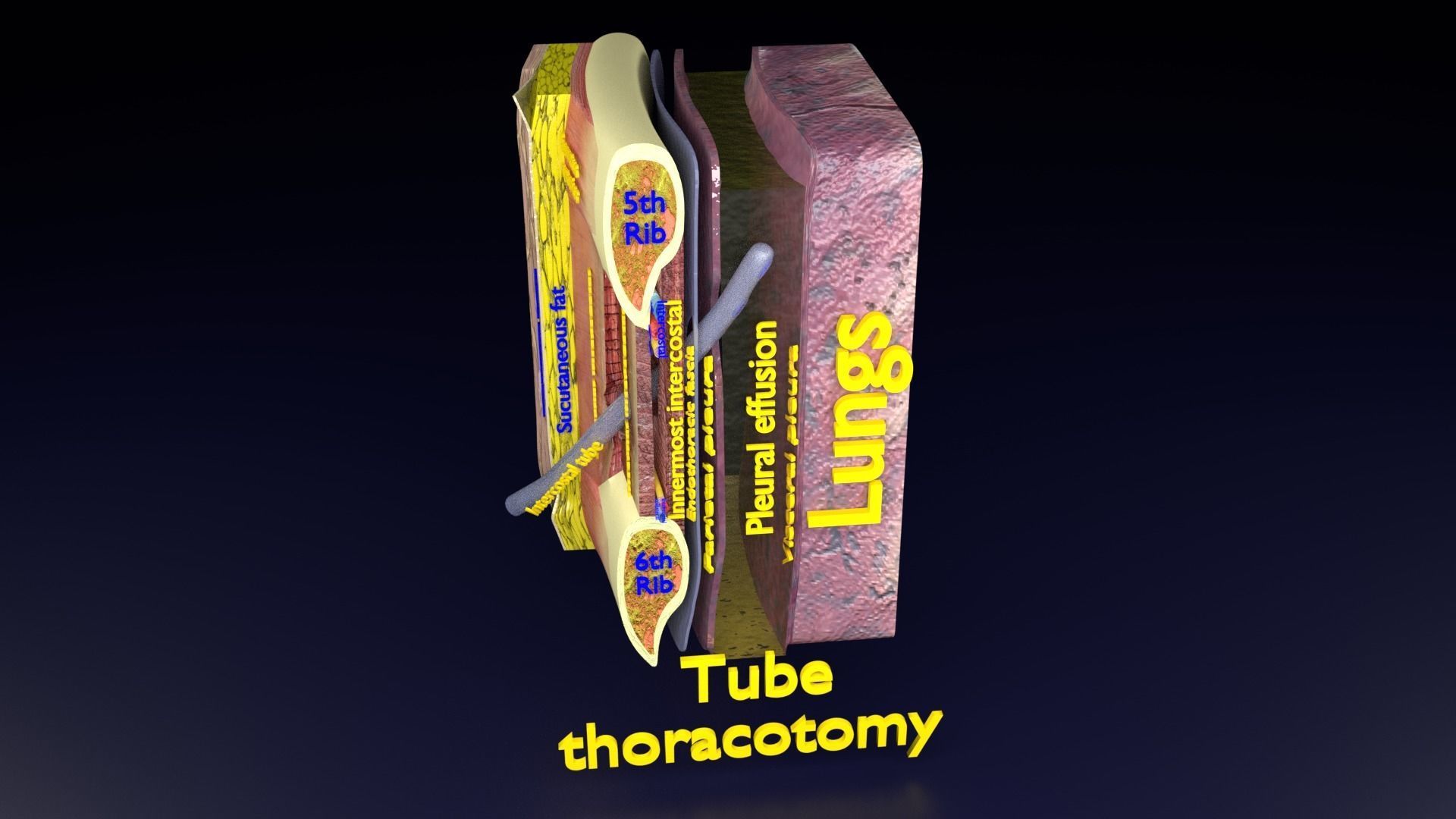 thorax thoracotomy thoracocentesis intercostal nerve block 3D model_43