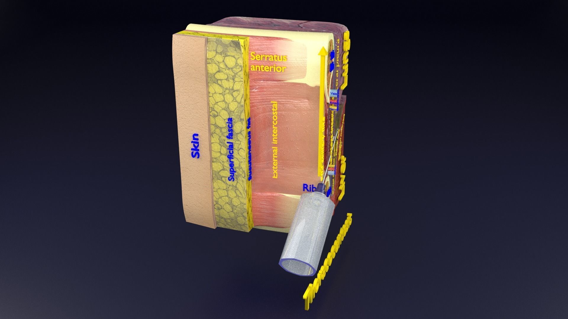 thorax thoracotomy thoracocentesis intercostal nerve block 3D model_77